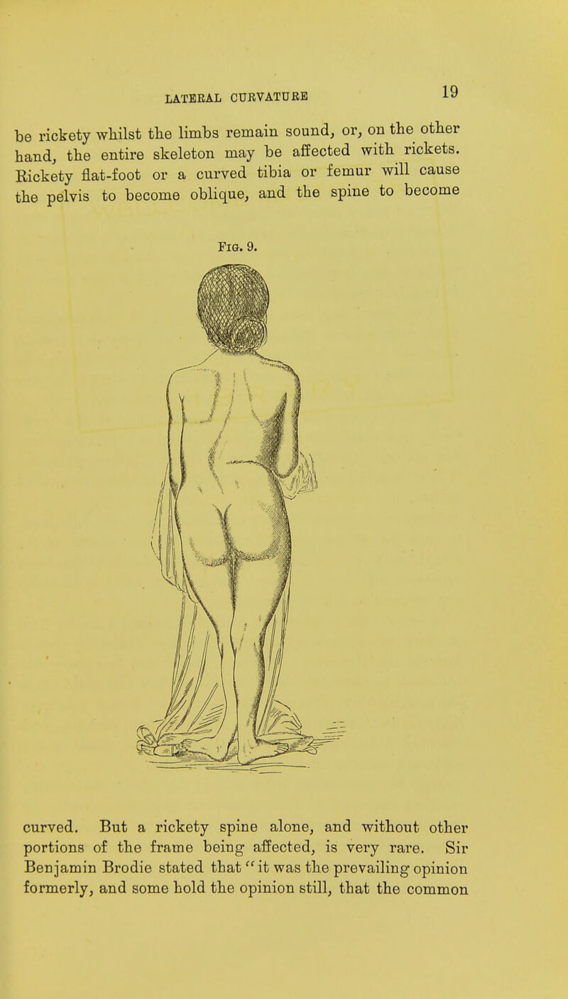 be rickety whilst the limbs remain sound, or, on the other hand, the entire skeleton may be affected with rickets. Rickety flat-foot or a curved tibia or femur will cause the pelvis to become oblique, and the spine to become Fig. 9. curved. But a rickety spine alone, and without other portions of the frame beiug affected, is very rare. Sir Benjamin Brodie stated that  it was the prevailing opinion formerly, and some hold the opinion still, that the common