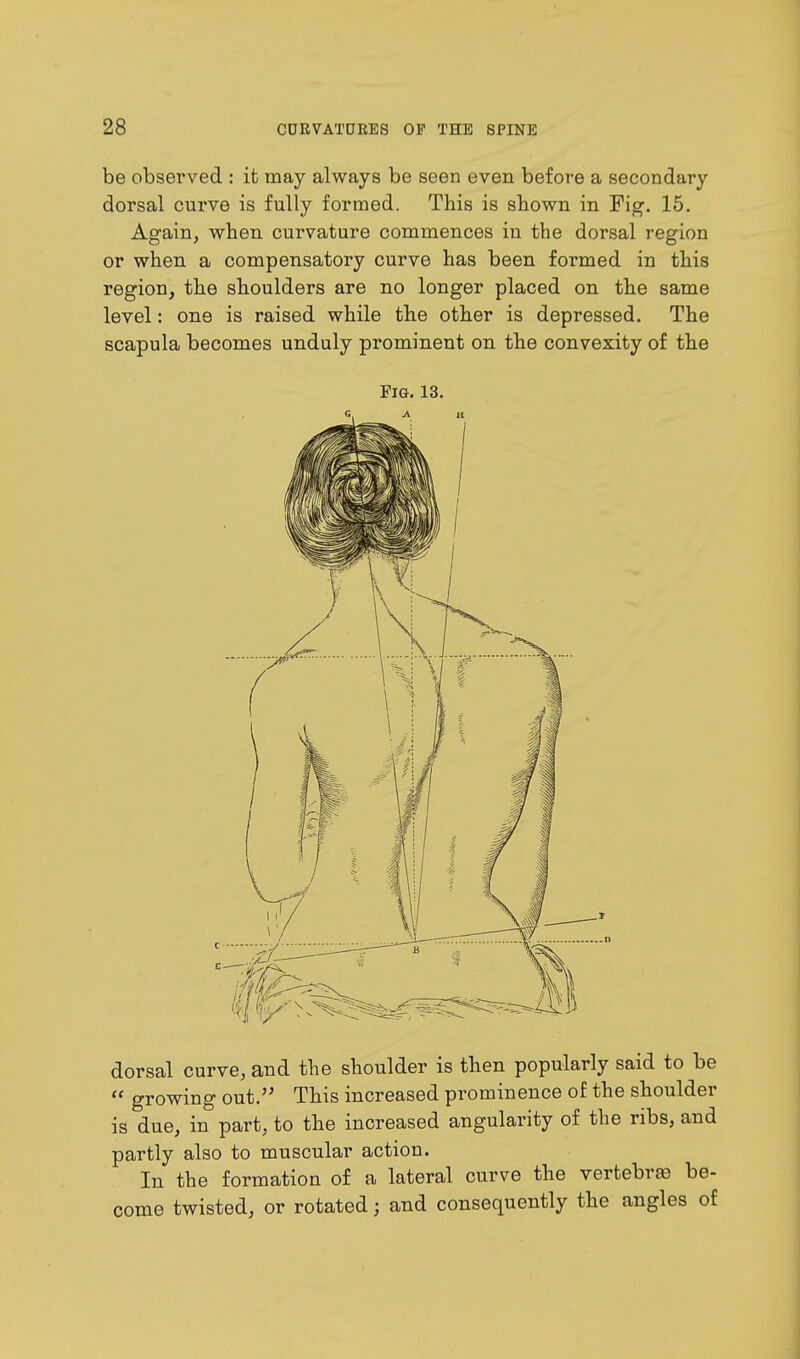 be observed : it may always be seen even before a secondary dorsal curve is fully formed. This is shown in Fig. 15. Again, when curvature commences in the dorsal region or when a compensatory curve has been formed in this region, the shoulders are no longer placed on the same level: one is raised while the other is depressed. The scapula becomes unduly prominent on the convexity of the Fig. 13. dorsal curve, and the shoulder is then popularly said to be  growing out. This increased prominence of the shoulder is due, in part, to the increased angularity of the ribs, and partly also to muscular action. In the formation of a lateral curve the vertebra? be- come twisted, or rotated; and consequently the angles of