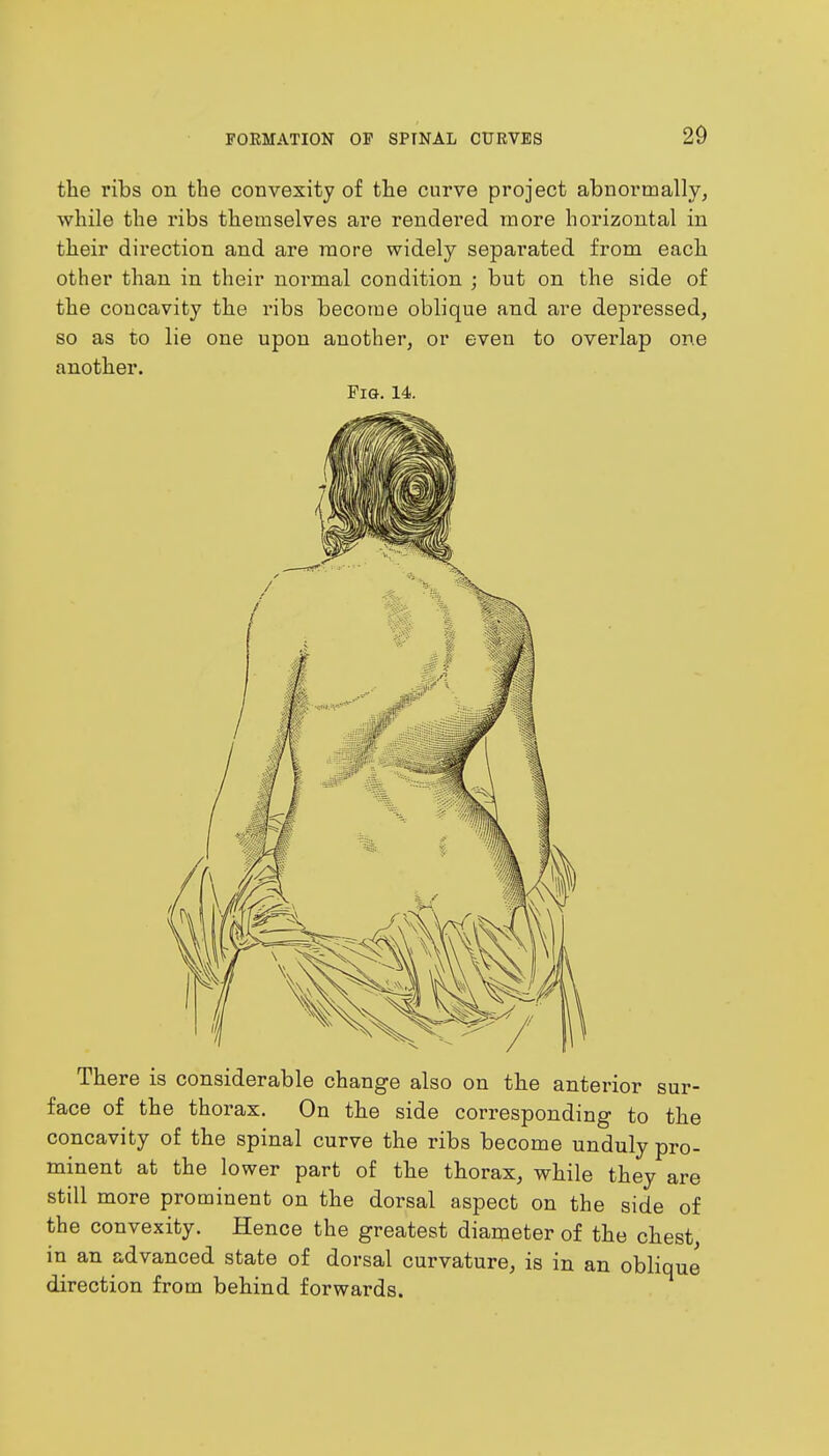 the ribs on the convexity of the curve project abnormally, while the ribs themselves are rendered more horizontal in their direction and are more widely separated from each other than in their normal condition ; but on the side of the concavity the ribs become oblique and are depressed, so as to lie one upon another, or even to overlap one another. Fig. 14. There is considerable change also on the anterior sur- face of the thorax. On the side corresponding to the concavity of the spinal curve the ribs become unduly pro- minent at the lower part of the thorax, while they are still more prominent on the dorsal aspect on the side of the convexity. Hence the greatest diameter of the chest, in an advanced state of dorsal curvature, is in an oblique direction from behind forwards.