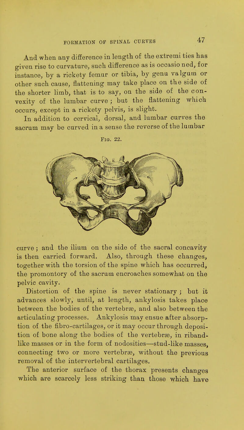 And when any difference in length of the extremi ties has given rise to curvature, such difference as is occasio ned, for instance, by a rickety femur or tibia, by genu valgum or other such cause, flattening may take place on the side of the shorter limb, that is to say, on the side of the con- vexity of the lumbar curve; but the flattening which occurs, except in a rickety pelvis, is slight. In addition to cervical, dorsal, and lumbar curves the sacrum may be curved in a sense the reverse of the lumbar Fig. 22. curve ; and the ilium on the side of the sacral concavity is then carried forward. Also, through these changes, together with the torsion of the spine which has occurred, the promontory of the sacrum encroaches somewhat on the pelvic cavity. Distortion of the spine is never stationary; but it advances slowly, until, at length, ankylosis takes place between the bodies of the vertebras, and also between the articulating processes. Ankylosis may ensue after absorp- tion of the fibro-cartilages, or it may occur through deposi- tion of bone along the bodies of the vertebras, in riband- like masses or in the form of nodosities—stud-like masses, connecting two or more vertebrae, without the previous removal of the intervertebral cartilages. The anterior surface of the thorax presents changes which are scarcely less striking than those which have