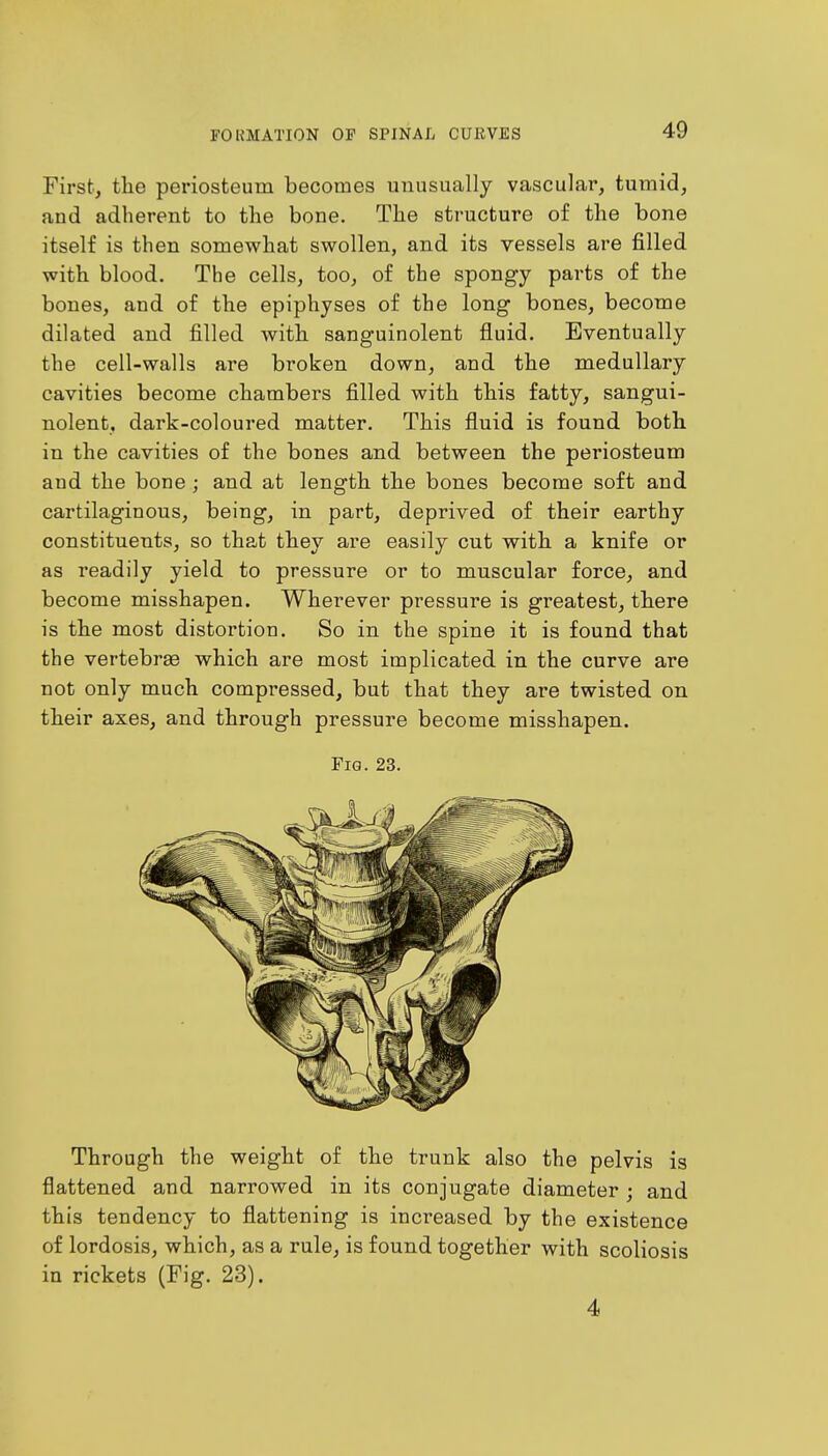 First, the periosteum becomes unusually vascular, tumid, and adherent to the bone. The structure of the bone itself is then somewhat swollen, and its vessels are filled with blood. The cells, too, of the spongy parts of the bones, and of the epiphyses of the long bones, become dilated and filled with sanguinolent fluid. Eventually the cell-walls are broken down, and the medullary cavities become chambers filled with this fatty, sangui- nolent, dark-coloured matter. This fluid is found both in the cavities of the bones and between the periosteum and the bone; and at length the bones become soft and cartilaginous, being, in part, deprived of their earthy constituents, so that they are easily cut with a knife or as readily yield to pressure or to muscular force, and become misshapen. Wherever pressure is greatest, there is the most distortion. So in the spine it is found that the vertebrae which are most implicated in the curve are not only much compressed, but that they are twisted on their axes, and through pressure become misshapen. Fig. 23. Through the weight of the trunk also the pelvis is flattened and narrowed in its conjugate diameter ; and this tendency to flattening is increased by the existence of lordosis, which, as a rule, is found together with scoliosis in rickets (Fig. 23). 4