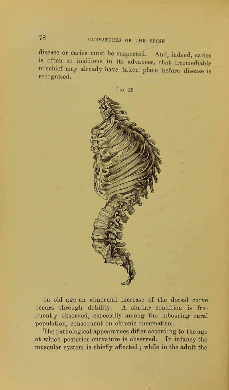 CURVATURES OP THE RPINE disease or caries must be suspected. And, indeed, caries is often so insidious in its advances, that irremediable mischief may already have taken place before disease is recognised. Fig. 29. In old age an abnormal increase of the dorsal curve occurs thi'ough debility. A similar condition is fre- quently observed, especially among the labouring rural population, consequent on chronic rheumatism. The pathological appearances differ according to the age at which posterior curvature is observed. In infancy the muscular system is chiefly affected; while in the adult the