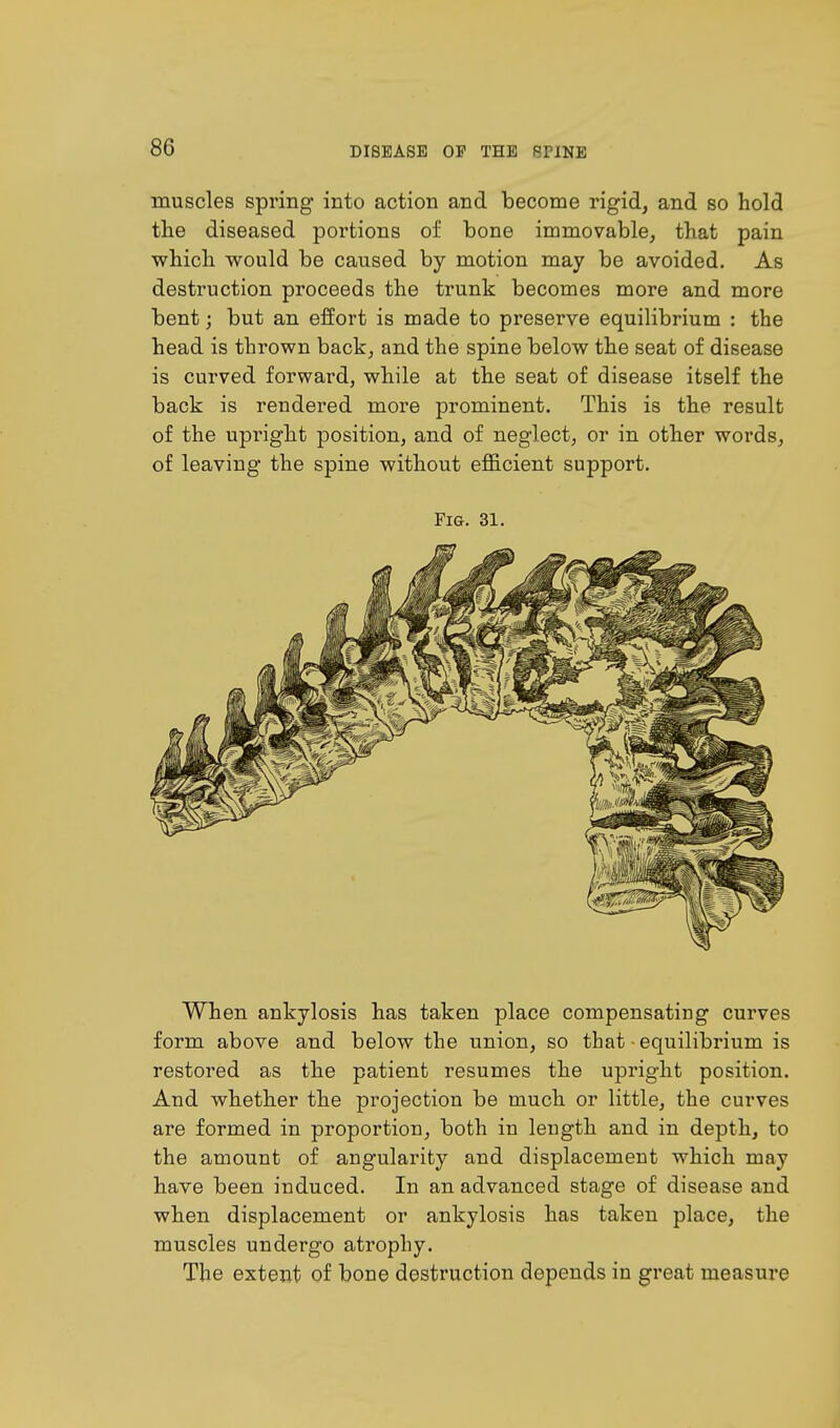 muscles spring into action and become rigid, and so hold the diseased portions of bone immovable, that pain which would be caused by motion may be avoided. As destruction proceeds the trunk becomes more and more bent; but an effort is made to preserve equilibrium : the head is thrown back, and the spine below the seat of disease is curved forward, while at the seat of disease itself the back is rendered more prominent. This is the result of the upright position, and of neglect, or in other words, of leaving the spine without efficient support. Fig. 31. When ankylosis has taken place compensating curves form above and below the union, so that ■ equilibrium is restored as the patient resumes the upright position. And whether the projection be much or little, the curves are formed in proportion, both in length and in depth, to the amount of angularity and displacement which may have been induced. In an advanced stage of disease and when displacement or ankylosis has taken place, the muscles undergo atrophy. The extent of bone destruction depends in great measure