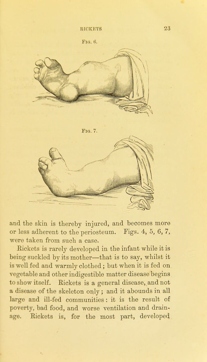 Fig. 6. and the skin is thereby injured, and becomes more or less adherent to the periosteum. Figs. 4, 5, 6, 7, were taken from such a case. Rickets is rarely developed in the infant while it is being suckled bj its mother—that is to say, whilst it is well fed and warmly clothed; but when it is fed on. vegetable and other indigestible matter disease begins to show itself. Rickets is a general disease, and not a disease of the skeleton only; and it abounds in all large and ill-fed communities : it is the result of poverty, bad food, and worse ventilation and drain- age. Rickets is, for the most part, developed