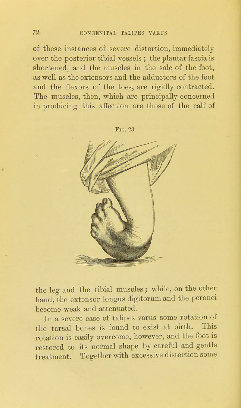 of these instances of severe distortion, immediately- over the posterior tibial vessels ; the plantar fascia is shortened, and the muscles in the sole of the foot, as well as the extensors and the adductors of the foot and the flexors of the toes, are rigidly contracted. The muscles, then, which are principally concerned in producing this aflFection are those of the calf of Fig. 23. the leg and the tibial muscles; while, on the other hand, the extensor longus digitorum and the peronei become weak and attenuated. In a severe case of talipes varus some rotation of the tarsal bones is found to exist at birth. This rotation is easily overcome, however, and the foot is restored to its normal shape by careful and gentle treatment. Together with excessive distortion some