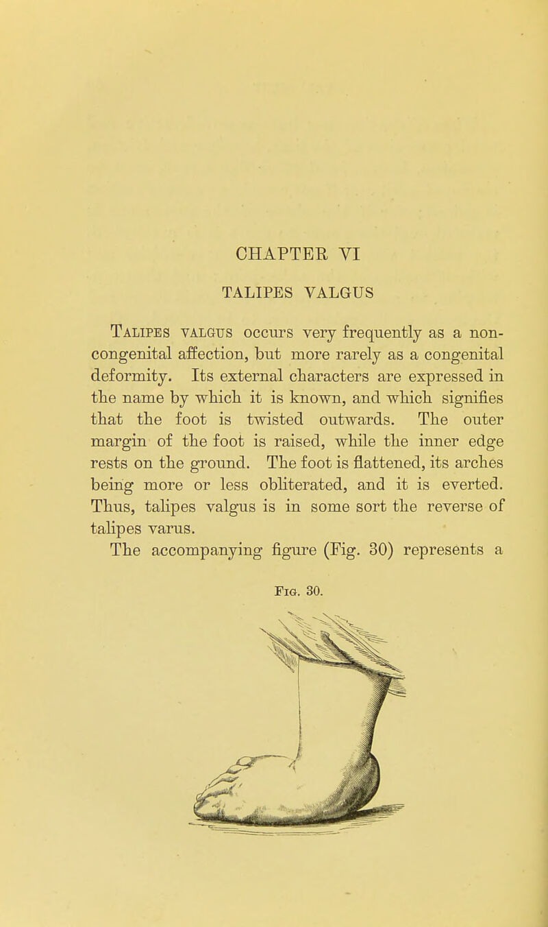 CHAPTER yi TALIPES VALGUS Talipes valgus occurs very frequently as a non- congenital affection, but more rarely as a congenital deformity. Its external characters are expressed in the name by which it is known, and which signifies that the foot is twisted outwards. The outer margin of the foot is raised, while the inner edge rests on the ground. The foot is flattened, its arches being more or less obliterated, and it is everted. Thus, talipes valgus is in some sort the reverse of talipes varus. The accompanying figure (Fig. 30) represents a