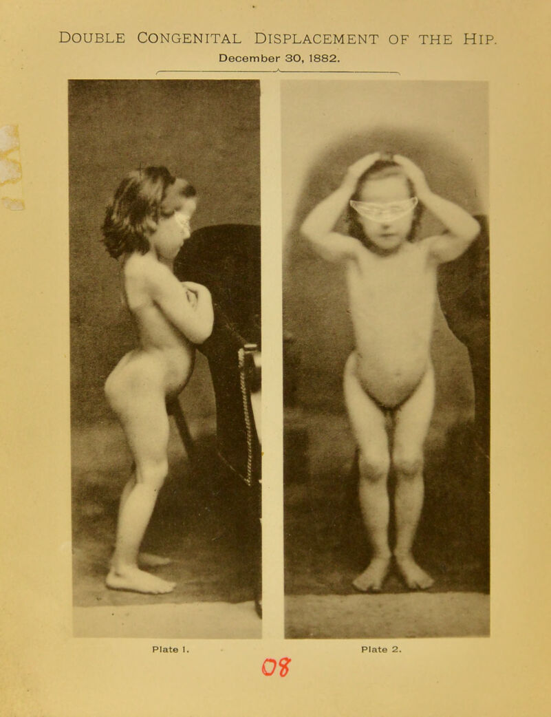 DOUBLE CONGENITAL DISPLACEMENT OF THE HiP. December 30, 1882.