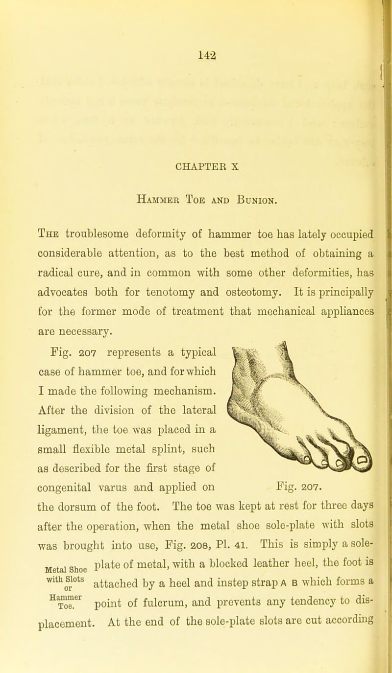 CHAPTEK X Hammer Toe and Bunion. The troublesome deformity of hammer toe has lately occupied considerable attention, as to the best method of obtaining a radical cure, and in common with some other deformities, has advocates both for tenotomy and osteotomy. It is principally for the former mode of treatment that mechanical appliances are necessary. Fig. 207 represents a typical case of hammer toe, and for which I made the following mechanism. After the division of the lateral ligament, the toe was placed in a small flexible metal splint, such as described for the first stage of congenital varus and applied on Fig. 207. the dorsum of the foot. The toe was kept at rest for three days after the operation, when the metal shoe sole-plate with slots was brought into use. Fig. 208, PL 41. This is simply a sole- Metal Shoe P^^*® °^ metal, with a blocked leather heel, the foot is with Slots 3_ttj^gi^g^ a heel and instep strap A B which forms a ^T^^^ point of fulcrum, and prevents any tendency to dis- placement. At the end of the sole-plate slots are cut according