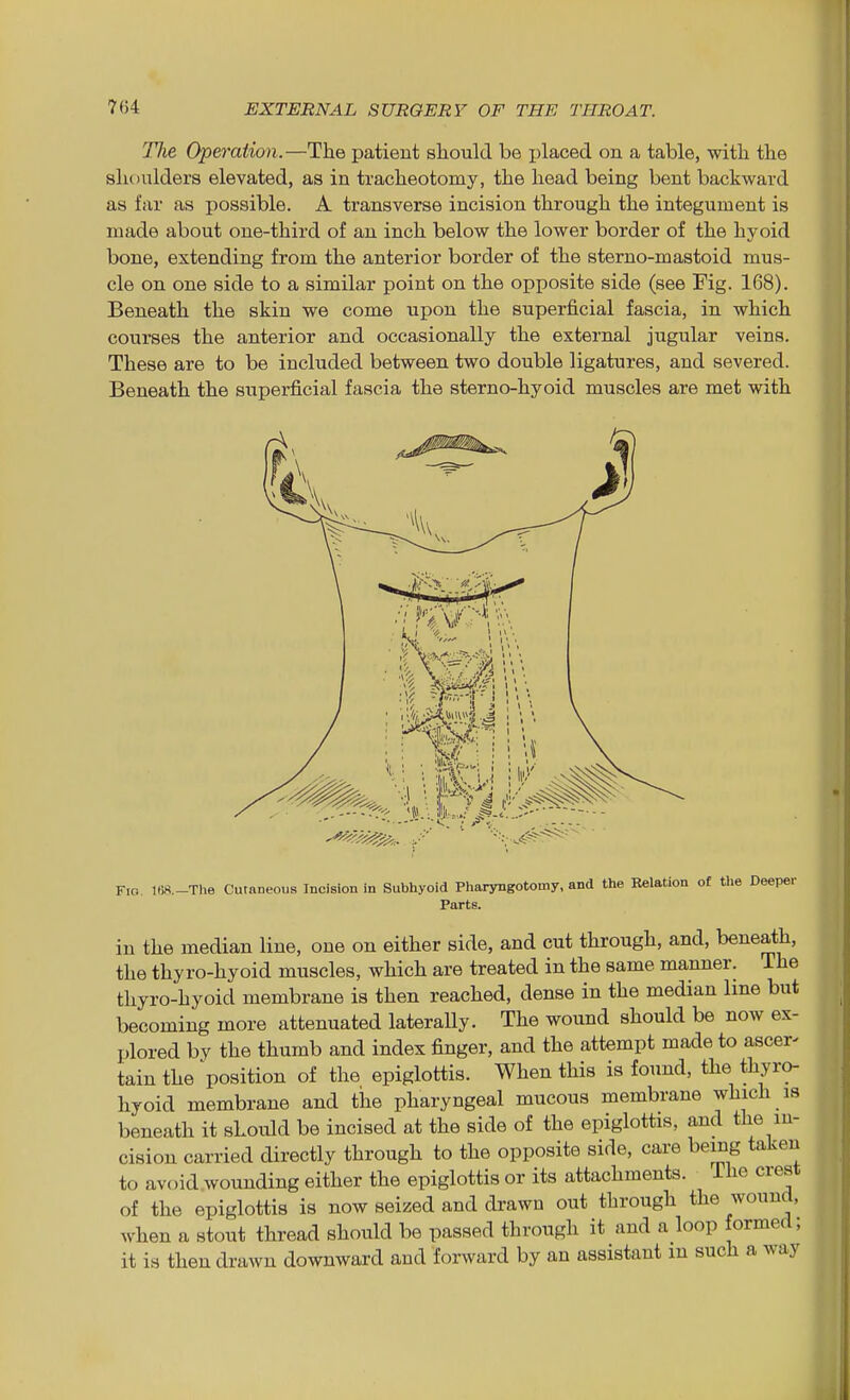 The Operation.—The patient sliould be placed on a table, with the shoulders elevated, as in tracheotomy, the head being bent backward as far as possible. A transverse incision through the integument is made about one-third of an inch below the lower border of the hyoid bone, extending from the anterior border of the sterno-mastoid mus- cle on one side to a similar point on the opposite side (see Fig. 168). Beneath the skin we come upon the superficial fascia, in which courses the anterior and occasionally the external jugular veins. These are to be included between two double ligatures, and severed. Beneath the superficial fascia the sterno-hyoid muscles are met with Fio. lt;«.-The CutnDeous Incision in Subhyoid Phaiyngotomy, and the Relation of tlie Deeper Parts. in the median line, one on either side, and cut through, and, beneath, the thyro-hyoid muscles, which are treated in the same manner. The thyro-hyoid membrane is then reached, dense in the median line but becoming more attenuated laterally. The wound should be now ex- plored by the thumb and index finger, and the attempt made to ascer- tain the position of the epiglottis. When this is found, the thyro- hyoid membrane and the pharyngeal mucous membrane which is beneath it should be incised at the side of the epiglottis, and the in- cision carried directly through to the opposite side, care being taken to avoid wounding either the epiglottis or its attachments. The crest of the epiglottis is now seized and drawn out through the wound, when a stout thread should be passed through it and a loop formed; it is then drawn downward and forward by an assistant m such a way