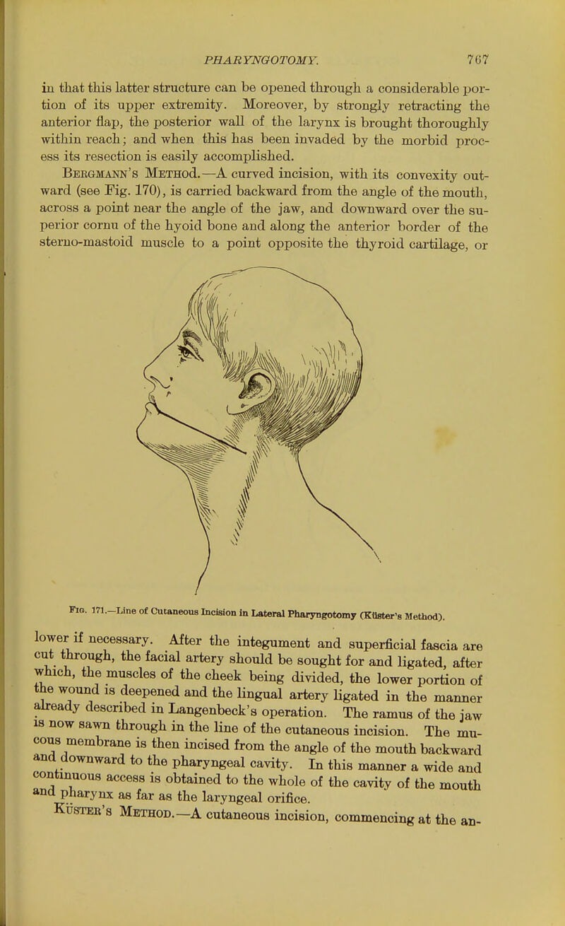 in that this latter structure can be opened through a considerable por- tion of its upijer extremity. Moreover, by strongly retracting the anterior flap, the posterior wall of the larynx is brought thoroughly within reach; and when this has been invaded by the morbid proc- ess its resection is easily accomplished. Bergmann's METHod.—A curved incision, with its convexity out- ward (see Fig. 170), is carried backward from the angle of the mouth, across a point near the angle of the jaw, and downward over the su- perior cornu of the hyoid bone and along the anterior border of the sterno-mastoid muscle to a point opposite the thyroid cartilage, or Fio. I71.-Line of Cutaneous Incision in Lateral Pharyngotomy (Kaster's Method). lower if necessary. After the integument and superficial fascia are cut through, the facial artery should be sought for and ligated, after which, the muscles of the cheek being divided, the lower portion of the wound 18 deepened and the lingual artery ligated in the manner already described in Langenbeck's operation. The ramus of the jaw 18 now sawn through in the line of the cutaneous incision. The mu- cous membrane is then incised from the angle of the mouth backward and downward to the pharyngeal cavity. In this manner a wide and continuous access is obtained to the whole of the cavity of the mouth and pharynx as far as the laryngeal orifice. KusTER's Method.-A cutaneous incision, commencing at the an-