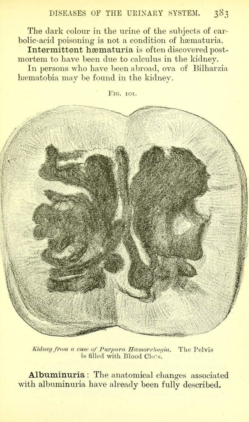 The dark colour in the urine of the subjects of car- bolic-acicl poisoning is not a condition of hematuria. Intermittent hsematuria is often discovered post- mortem to have been due to calculus in the kidney. In persons who have been abroad, ova of Bilharzia ha?matobia may be found in the kidney. Fig. ioi. Kidney from a case of Purpura Hcemorrhayia. The Pelvis is filled with Blood Clo^s. Albuminuria : The anatomical changes associated with albuminuria have already been fully described.