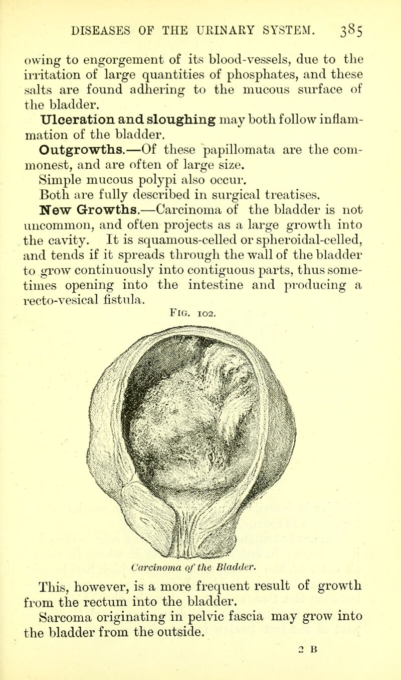 owing to engorgement of its blood-vessels, due to the irritation of large quantities of phosphates, and these salts are found adhering to the mucous surface of the bladder. Ulceration and sloughing may both follow inflam- mation of the bladder. Outgrowths.—Of these papillomata are the com- monest, and are often of large size. Simple mucous polypi also occur. Both are fully described in surgical treatises. New Growths.—Carcinoma of the bladder is not uncommon, and often projects as a large growth into the cavity. It is squamous-celled or spheroidal-celled, and tends if it spreads through the wall of the bladder to grow continuously into contiguous parts, thus some- times opening into the intestine and producing a recto-vesical fistula. Fig. 102. Carcinoma of the Bladder. This, however, is a more frequent result of growth from the rectum into the bladder. Sarcoma originating in pelvic fascia may grow into the bladder from the outside. 2 B
