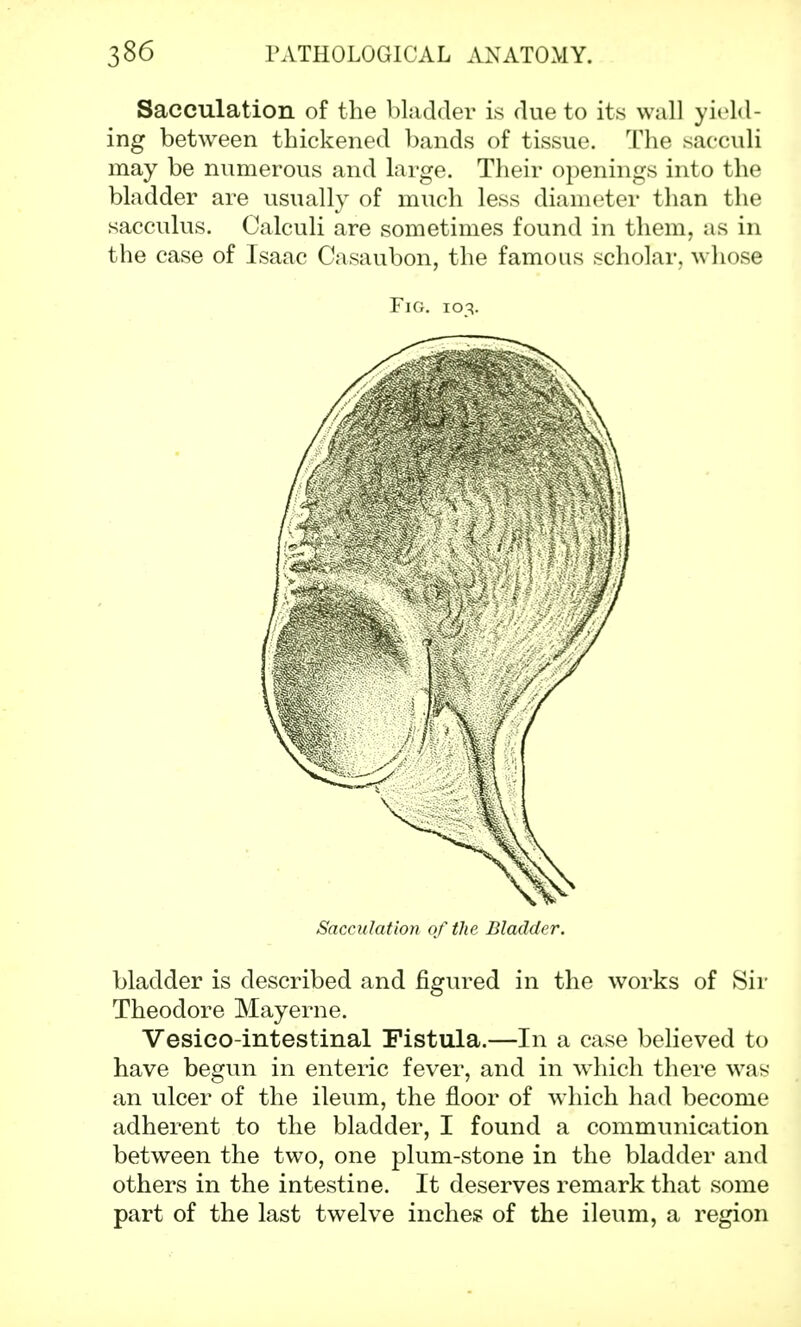 Sacculation of the bladder is due to its wall yield- ing between thickened bands of tissue. The sacculi may be numerous and large. Their openings into the bladder are usually of much less diameter than the sacculus. Calculi are sometimes found in them, as in the case of Isaac Casaubon, the famous scholar, whose Fig. 103. Sacculation of the Bladder. bladder is described and figured in the works of Sir Theodore Mayerne. Vesico-intestinal Fistula.—In a case believed to have begun in enteric fever, and in which there was an ulcer of the ileum, the floor of which had become adherent to the bladder, I found a communication between the two, one plum-stone in the bladder and others in the intestine. It deserves remark that some part of the last twelve inches of the ileum, a region