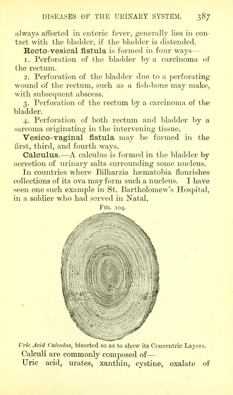 always .affected in enteric fever, generally lies in con- tact with the bladder, if the bladder is distended. Recto-vesical fistula is formed in four ways— 1. Perforation of the bladder by a carcinoma of the rectum. 2. Perforation of the bladder due to a perforating wound of the rectum, such as a fish-bone may make, with subsequent abscess. 3. Perforation of the rectum by a carcinoma of the bladder. 4. Perforation of both rectum and bladder by a sarcoma originating in the intervening tissue. Vesico-vaginal fistula may be formed in the first, third, and fourth ways. Calculus.—A calculus is formed in the bladder by accretion of urinary salts surrounding some nucleus. In countries where Bilharzia hsematobia flourishes collections of its ova may form such a nucleus. I have seen one such example in St. Bartholomew's Hospital, in a soldier who had served in Natal. Fig. 104. Uric Acid Calculus, bisected so as to show its Concentric Layers. Calculi are commonly composed of— Uric acid, urates, xanthin, cystine, oxalate of