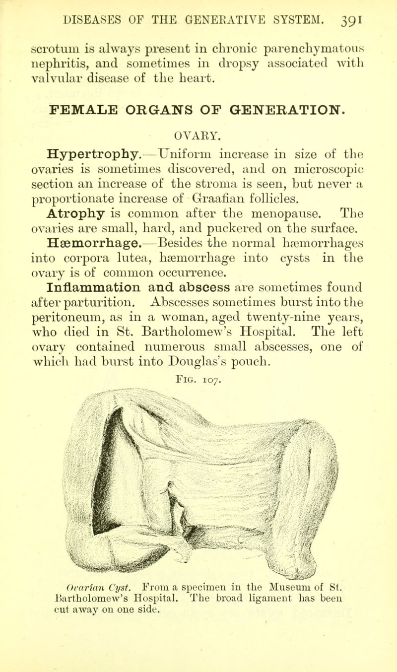 scrotum is always present in chronic parenchymatous nephritis, and sometimes in dropsy associated with valvular disease of the heart. FEMALE ORGANS OF GENERATION. OVABY. Hypertrophy.—Uniform increase in size of the ovaries is sometimes discovered, and on microscopic section an increase of the stroma is seen, but never a proportionate increase of Graafian follicles. Atrophy is common after the menopause. The ovaries are small, hard, and puckered on the surface. Haemorrhage.—Besides the normal hemorrhages into corpora lutea, haemorrhage into cysts in the ovary is of common occurrence. Inflammation and abscess are sometimes found after parturition. Abscesses sometimes burst into the peritoneum, as in a woman, aged twenty-nine years, who died in St. Bartholomew's Hospital. The left ovary contained numerous small abscesses, one of which had burst into Douglas's pouch. Fig. 107. Ovarian Cyst. From a specimen in the Museum of St. Bartholomew's Hospital. The broad ligament has been cut away on one side.