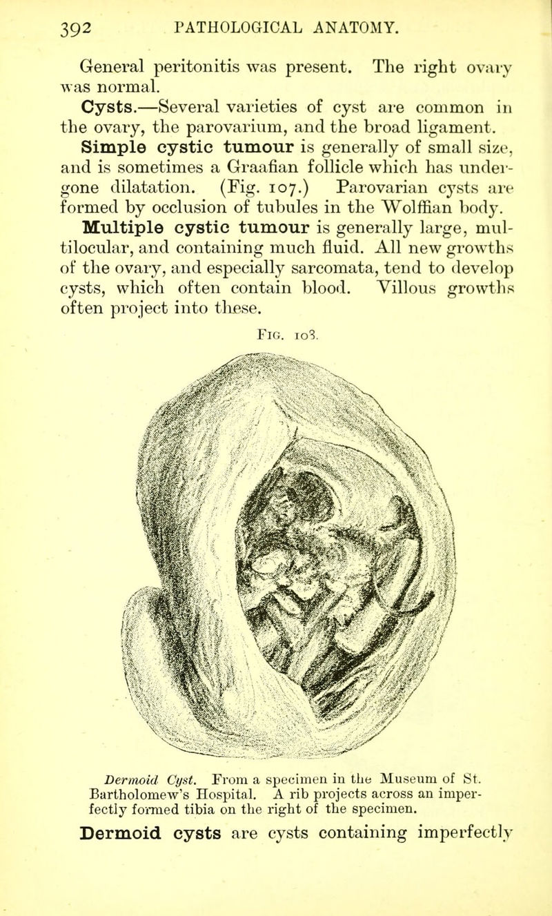 General peritonitis was present. The right ovary was normal. Cysts.—Several varieties of cyst are common in the ovary, the parovarium, and the broad ligament. Simple cystic tumour is generally of small size, and is sometimes a Graafian follicle which has under- gone dilatation. (Fig. 107.) Parovarian cysts are formed by occlusion of tubules in the Wolffian body. Multiple cystic tumour is generally large, mul- tilocular, and containing much fluid. All new growths of the ovary, and especially sarcomata, tend to develop cysts, which often contain blood. Villous growths often project into these. Fig. io3. Dermoid Cyst. From a specimen in the Museum of St. Bartholomew's Hospital. A rib projects across an imper- fectly formed tibia on the right of the specimen. Dermoid cysts are cysts containing imperfectly