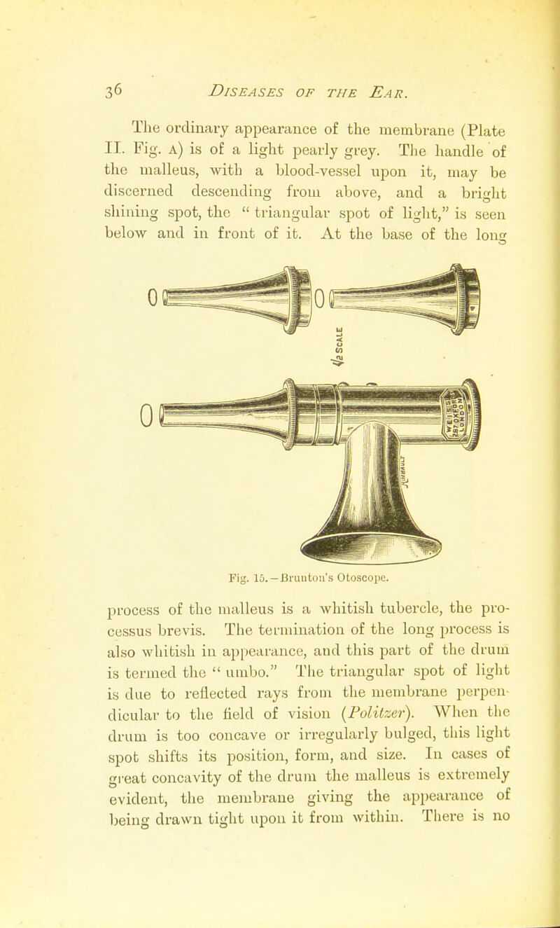 The ordinary appearance of the membrane (Plate II. Fig. a) is of a light pearly grey. The handle of the malleus, witb a blood-vessel upon it, may be discerned descending from above, and a bright shining spot, the  triangular spot of light, is seen below and in front of it. At the base of the long Fig. 10.—Bruuton's Otoscope. process of the malleus is a whitish tubercle, the pro- cessus brevis. The termination of the long process is also whitish in appearance, and this part of the drum is termed the  umbo. The triangular spot of light is due to reflected rays from the membrane perpen- dicular to the held of vision {Politzer). When the drum is too concave or irregularly bulged, this light spot shifts its position, form, and size. In cases of great concavity of the drum the malleus is extremely evident, the membrane giving the appearance of being drawn tight upon it from within. There is no