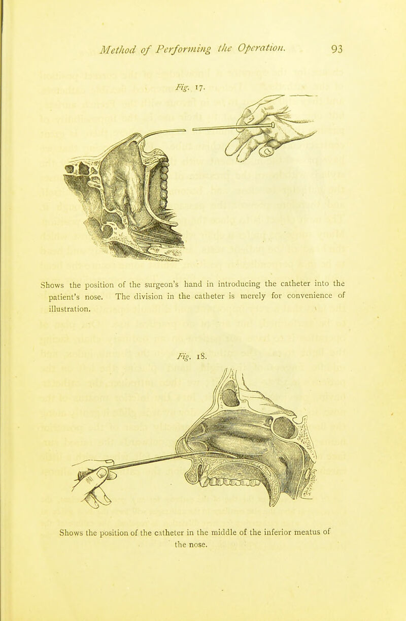 Shows the position of the catheter in the middle of the inferior meatus of the nose.