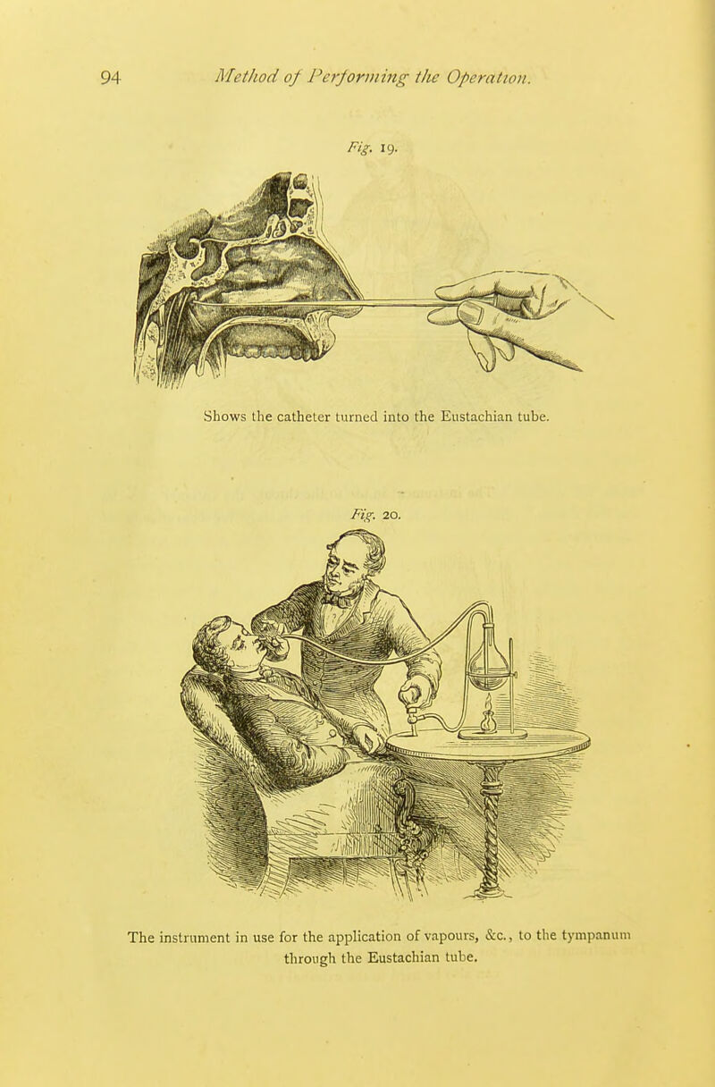 Fig. 19. Shows the catheter turned into the Eustachian tube. Fig. 20. The instrument in use for the application of vapours, &c., to the tympanum through the Eustachian tube.