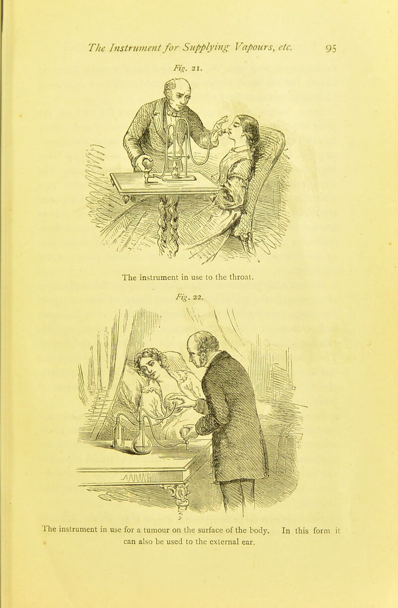 The instrument in use lo the throat. Fig. 22. The instrument in use for a tumour on the surface of the body. In this form it can also be used to the external ear.