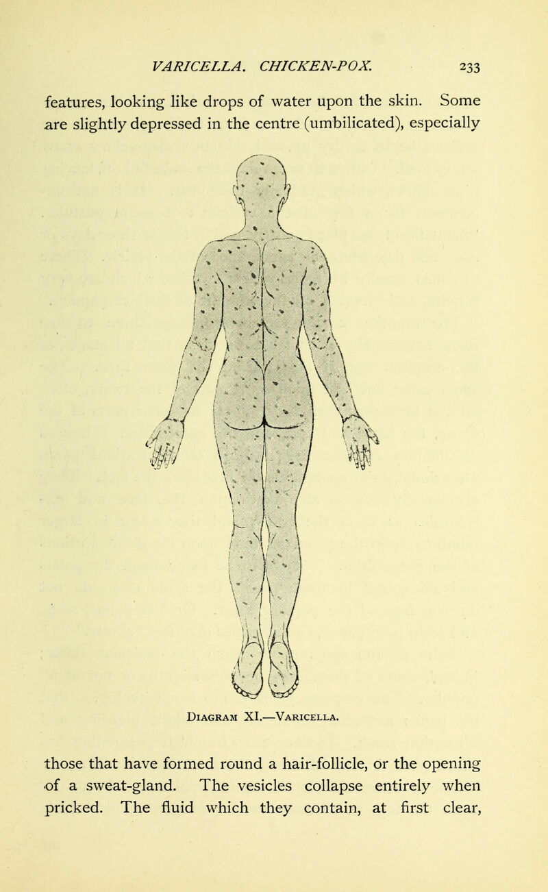 features, looking like drops of water upon the skin. Some are slightly depressed in the centre (umbilicated), especially Diagram XI.—Varicella. those that have formed round a hair-follicle, or the opening of a sweat-gland. The vesicles collapse entirely when pricked. The fluid which they contain, at first clear,