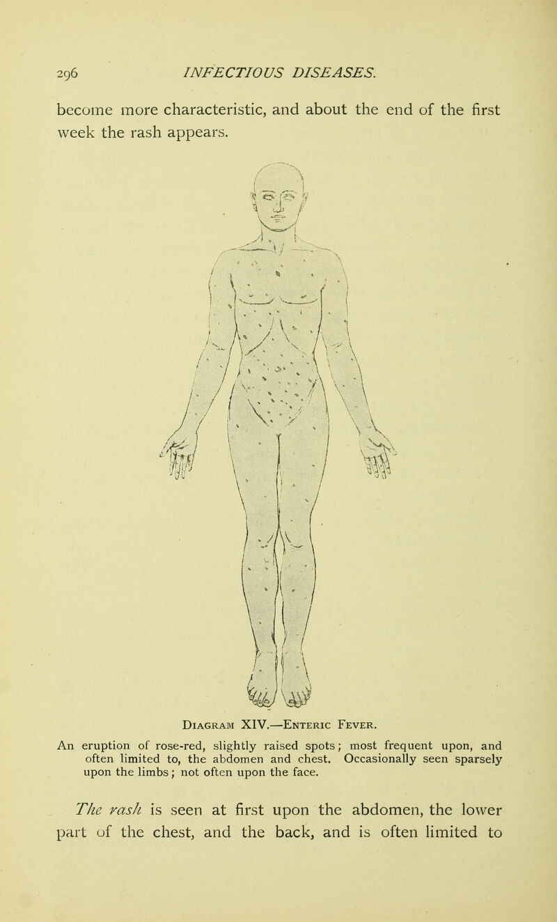 become more characteristic, and about the end of the first week the rash appears. Diagram XIV.—Enteric Fever. An eruption of rose-red, slightly raised spots; most frequent upon, and often limited to, the abdomen and chest. Occasionally seen sparsely upon the limbs; not often upon the face. The rash is seen at first upon the abdomen, the lower part uf the chest, and the back, and is often limited to