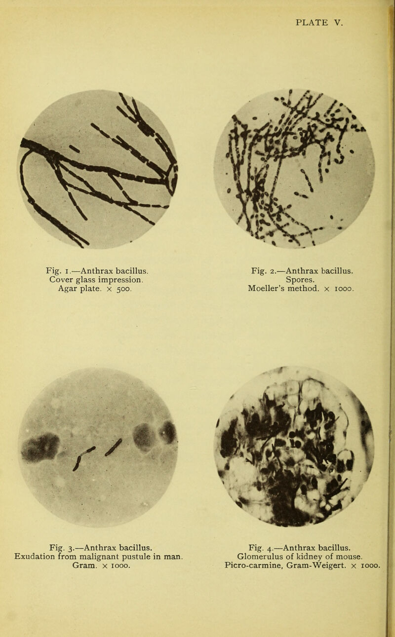 Fig. 3.—Anthrax bacillus. Exudation from malignant pustule in man. Gram, x 1000. Fig. 4.—Anthrax bacillus. Glomerulus of kidney of mouse. Picro-carmine, Gram-Weigert. x 1000.