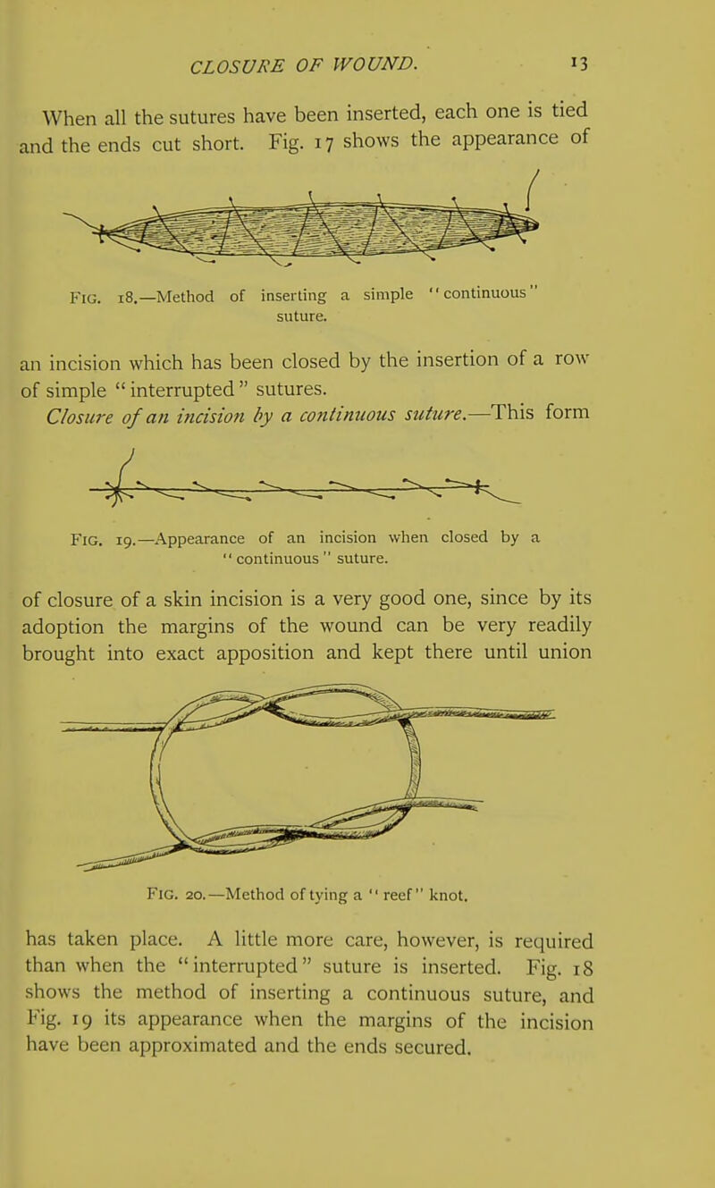 When all the sutures have been inserted, each one is tied and the ends cut short. Fig. 17 shows the appearance of Fig. 18,—Method of inserting a simple continuous suture. an incision which has been closed by the insertion of a row of simple  interrupted  sutures. Closure of an incision by a continuous suture.—This form Fig. 19.—Appearance of an incision when closed by a  continuous  suture. of closure of a skin incision is a very good one, since by its adoption the margins of the wound can be very readily brought into exact apposition and kept there until union Fig. 20.—Method of tying a  reef knot. has taken place. A little more care, however, is required than when the interrupted suture is inserted. Fig. 18 shows the method of inserting a continuous suture, and Fig. 19 its appearance when the margins of the incision have been approximated and the ends secured.