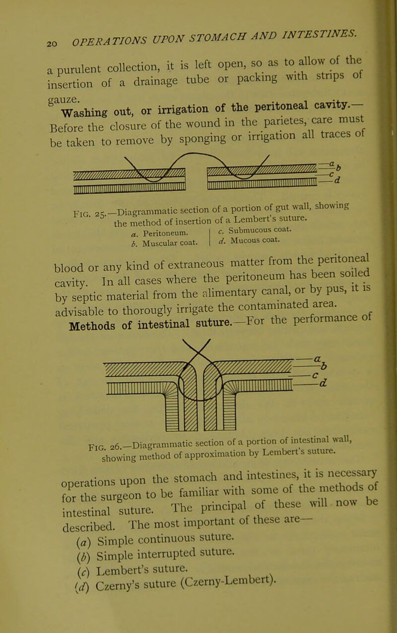 OPERATIONS UPON STOMACH AND INTESTINES. a purulent collection, it is left open, so as to allow of the insertion of a drainage tube or packing with strips of Washing out, or irrigation of the peritoneal cavity.- Before the closure of the wound in the parietes.^care must be taken to remove by sponging or irrigation all traces of P,G 2^ -Diagrammatic section of a portion of gut wall, showing ■ the method of insertion of a Lemberfs suture. a Peritoneum. I c. Submucous coat. b. Muscular coat. | d. Mucous coat. blood or any kind of extraneous matter from the peritoneal cavity In all cases where the peritoneum has been soiled by septic material from the alimentary canal, or by pus, it is advisable to thorougly irrigate the ^^^'^^^^''^^ ^'^^^^^^ ,f Methods of intestinal suture.-For the performance of Fig 26 -Diagrammatic section of a portion of intestinal wall, showing method of approximation by Lemberfs suture. operations upon the stomach and intestines, it is necessary for the surgeon to be familiar with some of the methods of fnLstLarfuture. The principal of these will now be described. The most important of these are- (fl) Simple continuous suture. ib) Simple interrupted suture. (c) Lemberfs suture. let) Czerny's suture (Czerny-Lembert).