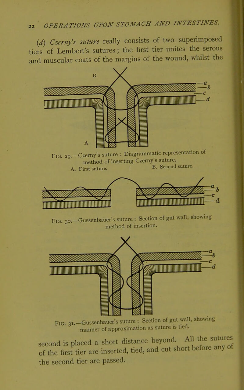 (d) Czerny's suture really consists of two superimposed tiers of Lembert's sutures; the first tier unites the serous and muscular coats of the margins of the wound, whilst the Fig. 29.-Czerny's suture : Diagrammatic representation of method of inserting Czerny's suture. A. First suture. B. Second suture. FIG. 30.-Gussenbauer's suture : Section of gut wall, shoNving method of insertion. Fig 3i.-Gussenbaucr's suture : Section of gut wall, showing manner of approximation as suture is tied. second is placed a short distance beyond. All the sutures of the first tier are inserted, tied, and cut short before any of the second tier are passed.