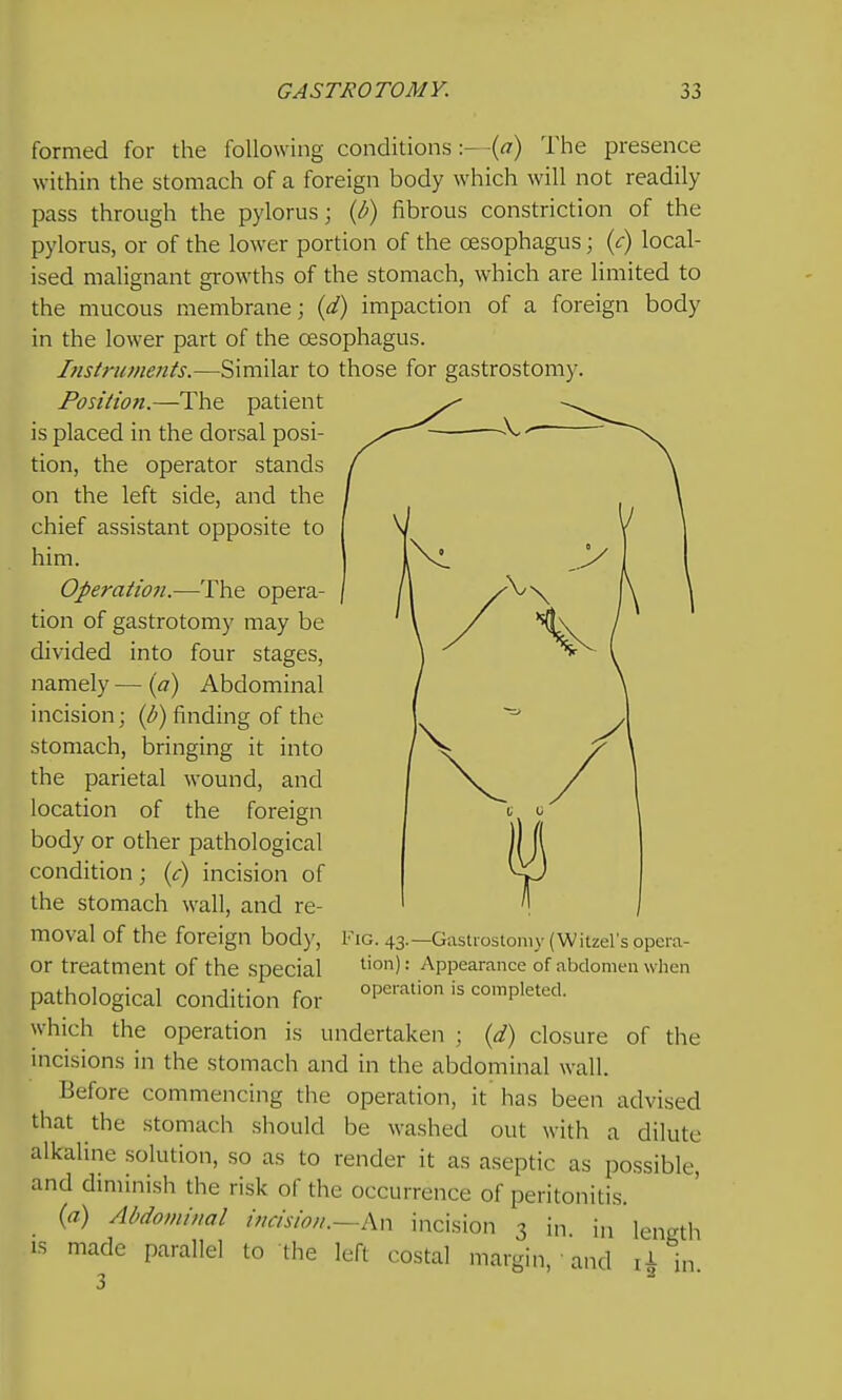 formed for the following conditions-{a) The presence within the stomach of a foreign body which will not readily pass through the pylorus; if) fibrous constriction of the pylorus, or of the lower portion of the oesophagus; (c) local- ised malignant growths of the stomach, which are limited to the mucous membrane; {d) impaction of a foreign body in the lower part of the CESophagus. Itistruments.—Similar to those for gastrostomy. Position.—The patient is placed in the dorsal posi- tion, the operator stands on the left side, and the chief assistant opposite to him. Operation.—The opera- tion of gastrotomy may be divided into four stages, namely — (a) Abdominal incision; ((^) finding of the stomach, bringing it into the parietal wound, and location of the foreign body or other pathological condition; {c) incision of the stomach wall, and re- moval of the foreign body, or treatment of the special pathological condition for which the operation is undertaken ; {d) closure of the incisions in the stomach and in the abdominal wall. Before commencing the operation, it has been advised that the stomach should be washed out with a dilute alkaline solution, so as to render it as aseptic as possible, and dmiinish the risk of the occurrence of peritonitis. {a) Abdominal incision.~hn incision 3 in in length IS made parallel to the left costal margin, and il in 3 ^ ■ Fig. 43.—Gastiostom\- (Witzel's opera- tion) : Appearance of abdomen when operation is completed.