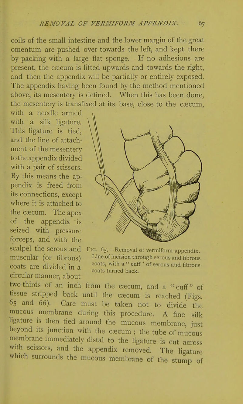 coils of the small intestine and the lower margin of the great omentum are pushed over towards the left, and kept there by packing with a large flat sponge. If no adhesions are present, the Ccecum is lifted upwards and towards the right, and then the appendix will be partially or entirely exposed. The appendix having been found by the method mentioned above, its mesentery is defined. When this has been done, the mesentery is transfixed at its base, close to the caecum, with a needle armed with a silk ligature. This Hgature is tied, and the line of attach- ment of the mesentery to the appendix divided with a pair of scissors. By this means the ap- pendix is freed from its connections, except where it is attached to the csecum. The apex of the appendix is seized with pressure forceps, and with the scalpel the serous and muscular (or fibrous) coats are divided in a circular manner, about two-thirds of an inch from the cjecum, and a cuff of tissue stripped back until the caecum is reached (Figs. 65 and 66). Care must be taken not to divide the mucous membrane during this procedure. A fine silk ligature is then tied around the mucous membrane, just beyond its junction with the ctecum ; the tube of mucous membrane immediately distal to the ligature is cut across with scissors, and the appendix removed. The ligature which surrounds the mucous membrane of the stump of Fig. 65.—Removal of vermiform appendix. Line of incision through serous and fibrous coats, with a  cuff of serous and fibrous coats turned back.