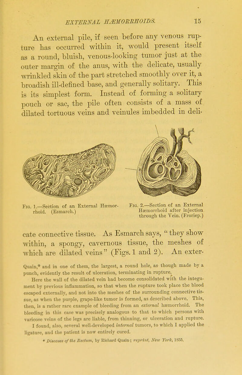 An external pile, if seen before any venous rup- ture has occurred within it, would present itself as a round, bluish, venous-looking tumor just at the outer margin of the anus, with the delicate, usually wrinkled skin of the part stretched smoothly over it, a broadish ill-defined base, and generally solitary. This is its simplest form. Instead of forming a solitary pouch or sac, the pile often consists of a mass of dilated tortuous veins and veinules imbedded in deli- Fig. 1.—Section of an External Hsemor- Fig. 2.—Section of an External rhoid. (Esmarch.) Hemorrhoid after injection through the Vein. (Froriep.) cate connective tissue. As Esmarch says,  they show within, a spongy, cavernous tissue, the meshes of which are dilated veins (Figs. 1 and 2). An exter- Quain * and in one of them, the largest, a round hole, as though made by a punch, evidently the result of ulceration, terminating in rupture^ Here the wall of the dilated vein had become consolidated with the integu- ment by previous inflammation, so that when the rupture took place the blood escaped externally, and not into the meshes of the surrounding connective tis- sue, as when the purple, grape-like tumor is formed, as described above. This, then, is a rather rare example of bleeding from an external hemorrhoid. The bleeding in thi3 case was precisely analogous to that to which persons with varicose veins of the legs are liable, from thinning, or ulceration and rupture. I found, also, several well-developed internal tumors, to which I applied the ligature, and the patient is now entirely cured. * Dtitant* of the /tectum, by Richard Quoin ; reprint, New York, 1855.