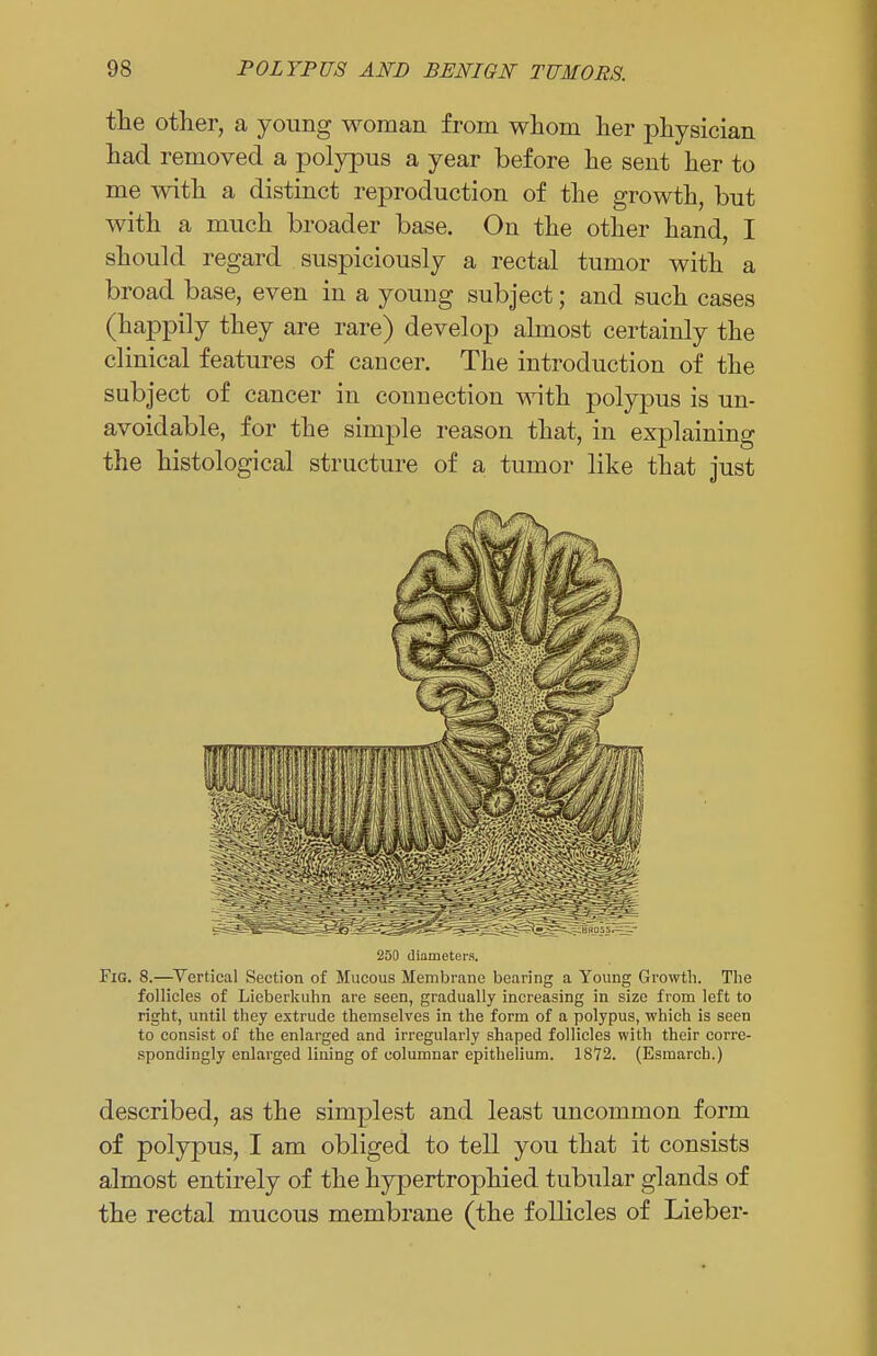 the other, a young woman from whom her physician had removed a polypus a year before he sent her to me with a distinct reproduction of the growth, but with a much broader base. On the other hand, I should regard suspiciously a rectal tumor with a broad base, even in a young subject; and such cases (happily they are rare) develop almost certainly the clinical features of cancer. The introduction of the subject of cancer in connection with polypus is un- avoidable, for the simple reason that, in explaining the histological structure of a tumor like that just 250 diameters. Fig. 8.—Vertical Section of Mucous Membrane bearing a Young Growth. The follicles of Lieberkuhn are seen, gradually increasing in size from left to right, until they extrude themselves in the form of a polypus, which is seen to consist of the enlarged and irregularly shaped follicles with their corre- spondingly enlarged lining of columnar epithelium. 1872. (Esmarch.) described, as the simplest and least uncommon form of polypus, I am obliged to tell you that it consists almost entirely of the hypertrophied tubular glands of the rectal mucous membrane (the follicles of Lieber-