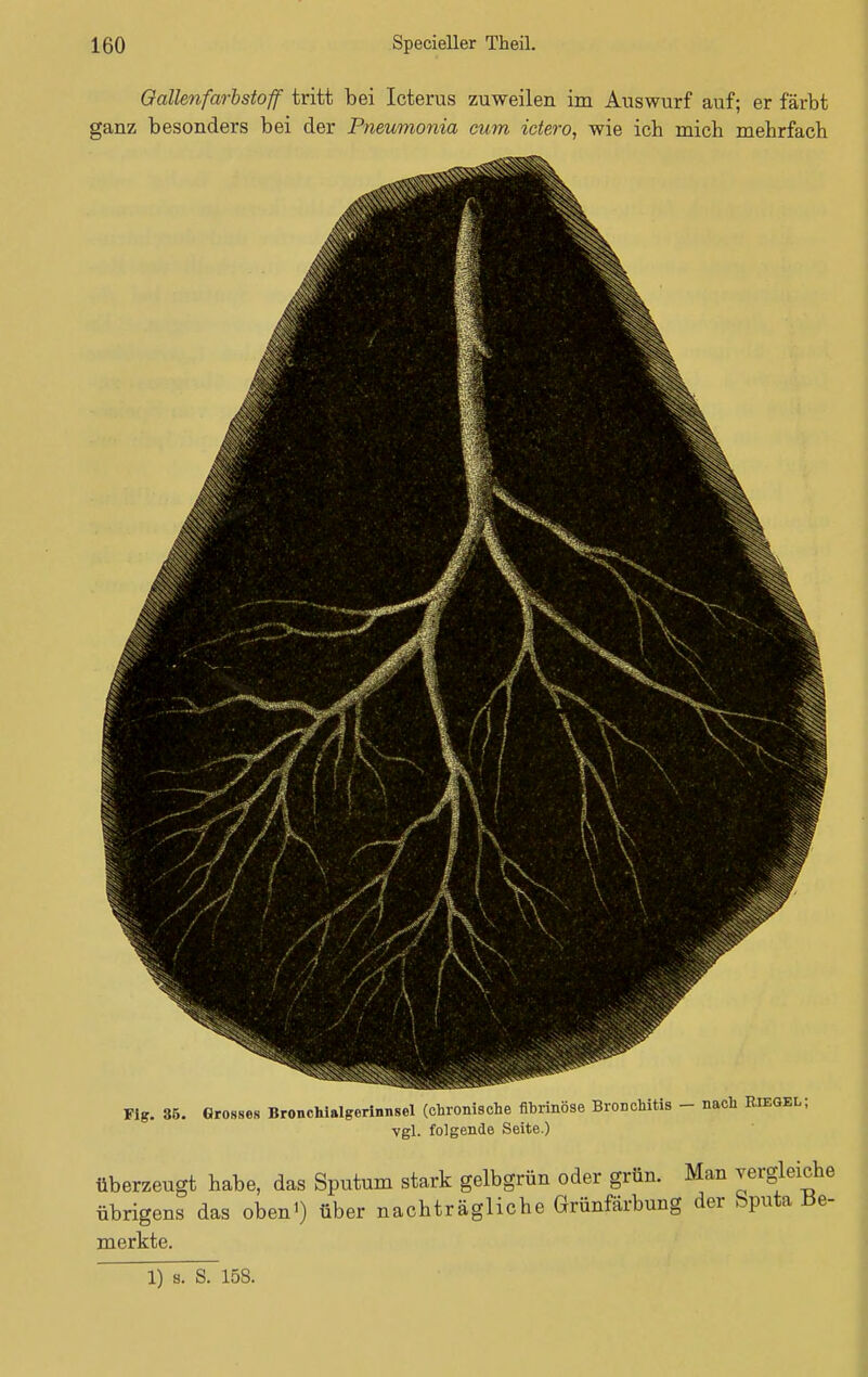 Qallenfarbstoff tritt bei Icterus zuweilen im Auswurf auf; er färbt ganz besonders bei der Pneumonie/, cum ictero, wie ich mich mehrfach Fig. 35. Grosse« Bronchialgerinnsel (chronische fibrinöse Bronchitis - nach Riegel; vgl. folgende Seite.) überzeugt habe, das Sputum stark gelbgrün oder grün. Man vergleiche übrigens das obeni) über nachträgliche Grünfärbung der bputa be- merkte.