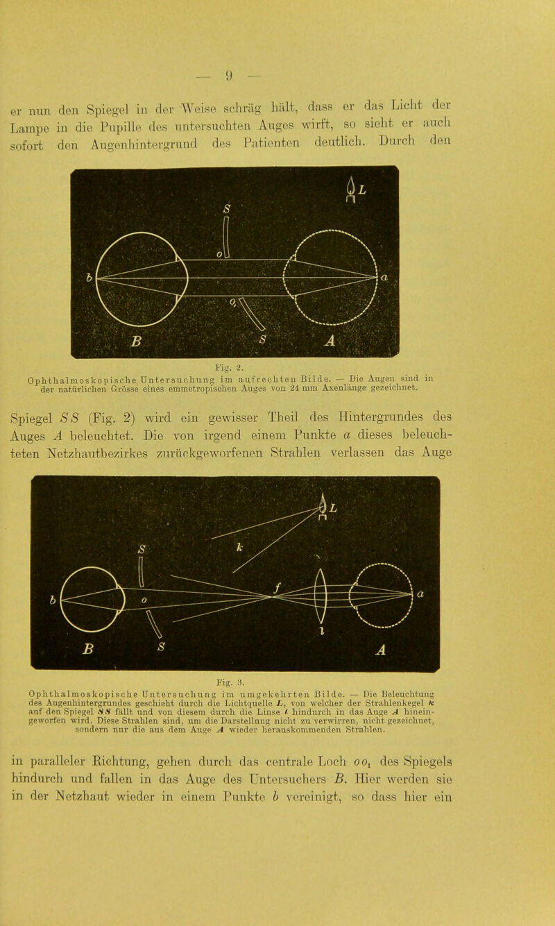 er nun den Spiegel in der AVeise scliräg hillt, dass er das Licht der Lampe in die Pupille des untersuchten Auges wirft, so sieht er auch sofort den Augenhintergrund des Patienten deutlich. Durcli den Oplitlialmoskopisclie üntersucliung im aufrecliten Bilde. — Die Augen sind in der natürliclien Grösse eines emmetropisciien Auges von 24 mm Axenlänge gezeichnet. Spiegel SS (Fig. 2) wird ein gewisser Theil des Hintergrundes des Auges Ä beleuchtet. Die von irgend einem Punkte a dieses beleuch- teten Netzhautbezirkes zurückgeworfenen Strahlen verlassen das Auge Fig. :!. Ophthalmoskopische Untersuchung im umgekehrten Bilde. — Die Beleuchtung des Augenhintergrundes geschieht durch die Lichtquelle L, von welcher der Strahlenkegel *c auf den Spiegel SS fällt und von diesem durch die Linse liindurch in das Auge J hinein- geworfen wird. Diese Strahlen sind, um die Darstellung nicht zu verwirren, nicht gezeichnet, sondern nur die aus dem Auge A wieder herauskommenden Strahlen. in paralleler Richtung, gehen durch das centrale Loch oo, des Spiegels hindurch und fallen in das Auge des Untersuchers B. Hier werden sie in der Netzhaut wieder in einem Punkte b vereinigt, so dass hier ein