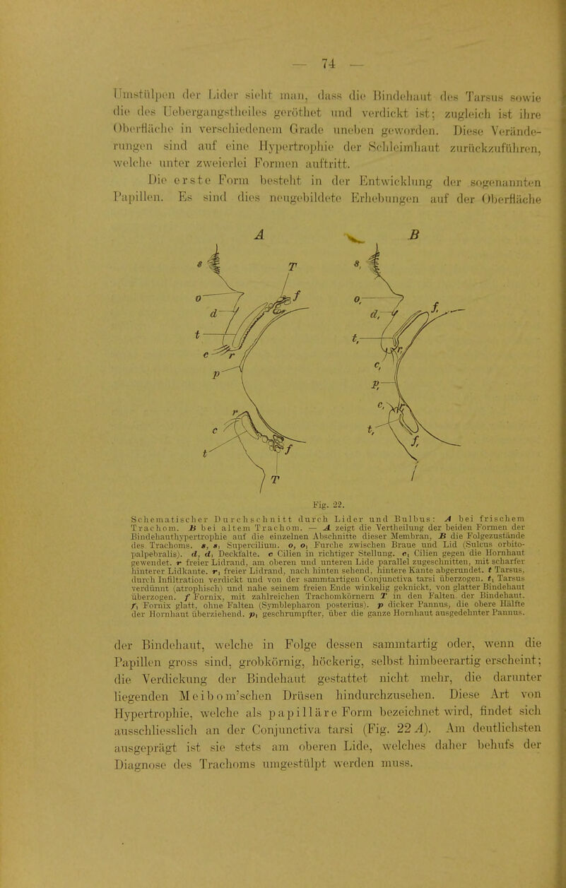 Ünistülpon der Lider ^ivht man, dass diu iiindeliaut des Tarsus sowie die des Uebergangstlieiles gerötliet und verdickt ist; zugleich ist ihre Oberfläche in verschiedenein Grade uneben geworden. Diese Verände- rungen sind auf eine Hypertropliie der KSchleimluiut zurrickzufüljren, welche unter zweierlei Formen auftritt. Die erste Form besteht in der Entwicklung der sogenannten Papillen. Es sind dies neugebildete Erhebungen auf der Oljerliäche Fig. 22. Scliematischer D ii r c Ii s c Ii n i tt durch Lider und Bulbus: A bei frischem Trachom. JK bei altem Trachom. — ^ zeigt die Vertheilung der beiden Fennen der Bindehauthyportrophie auf die einzelnen Abschnitte dieser Membran, JB die Folgezustände des Trachoms, e, a, Supercilium. o, o, Furche zwischen Braue und Lid (Sulcus orbito- palpebralis). d, d, Deckfalte, c Cilien in richtiger Stellung, «i Cilien gegen die Hornhaut gewendet, r freier Lidrand, am oberen und unteren Lide parallel zugeschnitten, mit scharfer hinterer Lidkante, r, freier Lidrand, nach hinten sehend, hintere Kante abgerundet, t Tarsus, durch Infiltration verdickt und von der sammtartigen Con.iunctiva tarsi überzogen. *i Tarsus verdünnt (atrophisch) und nahe seinem freien Ende winkelig geknickt, von glatter Bindehaut überzogen. / Fornix. mit zahlreichen Trachomkörnern T in den Falten der Bindehaut. /, Fornix glatt, ohne Falteu (.Symblepharon posterius), p dicker Pannus, die obere Hälfte der Hornhaut überziehend, p, geschrumpfter, über die ganze Hornhaut ausgedehnter Pannus. der Bindehaut, welche in Folge dessen sammtartig oder, wenn die Papillen gross sind, grobkörnig, höckerig, selbst himbeerartig erscheint; die Verdickung der Bindehaut gestattet nicht mehr, die darunter liegenden Meibom'sehen Drüsen hindurchzusehen. Diese Art von Hypertrophie, welche als papilläre Form bezeichnet wird, findet sich ausschliesslich an der Conjunctiva tarsi (Fig. 22 Ä). Am deutlichsten ausgeprägt ist sie stets am oberen Lide, welclies daher behufs der Diagnose des Trachoms umgestülpt werden muss.