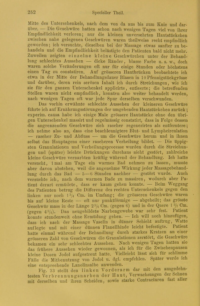 Mitte des UntersclienkelSj nach dem von da aus bis zum Knie und dar- über. — Die Geschwüre hatten schon nach wenigen Tagen viel von ihrer Empfindlichkeit verloren; nur die kleinen unversehrten Hautstückchen zwischen nahe gelegenen Gesehwüren waren theilweise recht empfindlich geworden; ich versuchte, dieselben bei der Massage etwas sanfter zu be- handeln und die Empfindlichkeit belästigte den Patienten bald nicht mehr. Zuweilen zeigten einzelne kleine Geschwürchen unter der Behand- lung schlechtes Aussehen — dicke Ränder, blasse Farbe u. s. w., doch waren solche Veränderungen oft nur für einige Stunden oder höchstens einen Tag zu constatiren. Auf grösseren Hautbrücken beobachtete ich etwa in der Mitte der Behandlungsdauer Blasen in 10 Pfennigstückgrösse und darüber, deren rein serösen Inhalt ich durch Streichungen, wie ich sie für den ganzen Unterschenkel applicirte, entleerte; die betreffenden Stellen waren nicht empfindlich, konnten also weiter behandelt werden, nach wenigen Tagen oft war jede Spur derselben verschwunden. Das vorhin erwähnte schlechte Aussehen der kleineren Geschwüre führte ich auf Ernährungsstörungen der umgebenden Hautstückchen zurück; experim. causa habe ich einige Male grössere Hautstücke ohne den übri- gen Unterschenkel massirt und regelmässig constatirt, dass in Folge dessen die angrenzenden Geschwüre sich rascher regenerirten als entferntere; ich nehme also an, dass eine beschleunigtere Blut- und Lymphcirculation — rascher Zu- und Abfluss — um die Geschwüre herum und in ihnen selbst das Hauptagens einer rascheren Verheilung bildet. — Die üppig- sten Granulationen und Verheilungsprocesse wurden durch die Streichun- gen und (später) leichte Drückungen durchaus nicht gestört, zahlreiche kleine Geschwüre vernarbten kräftig während der Behandlung. Ich hatte versucht, Imal am Tage ein warmes Bad nehmen zu lassen, musste aber davon abstehen, weil die angenehme Wirkung jeder Massagebehand- lung durch das Bad — 5—6 Stunden nachher — gestört wmrde. Auch versuchte ich, nach dem warmen Bade zu massiren, wodurch aber Pa- tient derart ermüdete, dass er kaum gehen konnte. — Beim Weggang des Patienten betrug die Differenz des rechten Unterschenkels gegen den linken nur noch 1^/4 Cm. im Umfang; die grösseren Geschwüre waren bis auf kleine Reste — oft nur punktförmige — abgeheilt; das grösste Geschwür mass iu der Länge 2^/4 Cm. (gegen 6) und in der Quere 1 */i Cm. (gegen 4=^/4). Das neugebildete Narbengewebe war sehr fest. Patient konnte stundenweit ohne Ermüdung gehen. — Ich will noch hinzufügen, dass ich nach der Massage Vaselin in dünner Schicht auftrug, Watte auflegte und mit einer dünnen Flanellbinde leicht befestigte. Patient hatte einmal während der Behandlung durch starkes Kratzen an einer grösseren Zahl von Geschwüren die Granulationen zerstört, die Geschwüie bekamen ein sehr schlechtes Aussehen. Nach wenigen Tagen hatten sie das frühere Aussehen wieder gewonnen, als ich für die Zwischenpausen kleine Dosen Jodol aufgestreut hatte. Vielleicht lässt sich für schlimme Fälle die Mitbenutzung von Jodol u. dgl. empfehlen. Später werde leh eine entsprechende Lanolinsalbe anwenden. Fig. 33 stellt den linken Vorderarm dar mit den ausgedehn- testen Verbrennungsnarben der 11 au t, Verwachsungen der Sehnen mit derselben und ihren Scheiden, sowie starke Contracturen fast aller