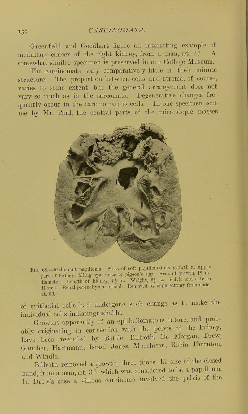 Greenfield and Goodhart figure an interesting example of medullary cancer of the right kidney, from a man, tet. 37. A somewhat similar specimen is preserved in our College Museum. The carcinomata vary comparatively little in their minute structure. The proportion between cells and stroma, of course, varies to some extent, but the general arrangement does not vary so much as in the sarcomata. Degenerative changes fre- quently occur in the carcinomatous cells. In one specimen sent me by Mr. Paul, the central parts of the microscopic masses Fig. 6S.—Maliguaut papilloma. Mass of soft papillomatous growth at upper iiart of kidney, filling space size of pigeon's egg. Area of growth, IJ m. clian.eter. Length of kidney, 5i in. Weight, 64 oz. Pelvis and calyces dilated. Renal paieuchynia normal. Kenioved by nephrectomy from male, a;t. 56. of epithelial cells had undergone such change as to make the individual cells indistinguishable. Growths apparently of an epitheliomatous nature, and prob- ably originating in connection with the pelvis of the kidney, have been recorded by Battle, Billroth, De Morgan, Drew, Gaucher, Hartmann, Israel, Jones, Murchison, Eobm, Thornton, and Windle. . , Billroth removed a growth, three times the size of the closed hand, from a man, tet. 33, which was considered to be a papilloma. In Drew's case a villous carcinoma involved the pelvis of the