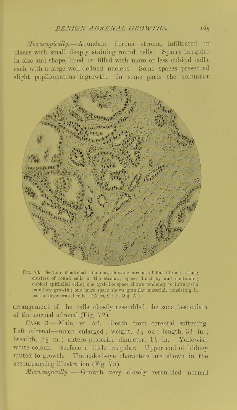 Microscopically.—Abundant fibrous stroma, infiltrated in places with small deeply staining round cells. Spaces irregular in size and shape, lined or filled with more or less cubical cells, each with a large well-defined nucleus. Some spaces presented slight papillomatous ingrowth. In some parts the columnar Fig. 73.—Section of adrenal adenoma, .showiug stroma of fine fibrous tissue ; clusters of round cells in the stroma ; spaces lined by aud containing cubical epitlielial cells ; one cyst-like space shows tendency to intracystic papillary growth ; one large space shows granular material, consisting in part of degenerated cells. (Zeiss, Oc. 2, Obj. A.) arrangement of the cells closely resembled the zona fasciculata of the normal adrenal (Fig. 72). Case 2.—Male, tet. 56. Death from cerebral softening. Left adrenal—much enlarged; weight, 3 J oz.; length, 3| in.; breadth, 2| in.; antero-posterior diameter, in. Yellowish white colour. Surface a little irregular. Upper end of kidney united to growth. The naked-eye characters are shown in the accompanying illustration (Fig. 75). Microscopically. — Growth very closely resembled normal