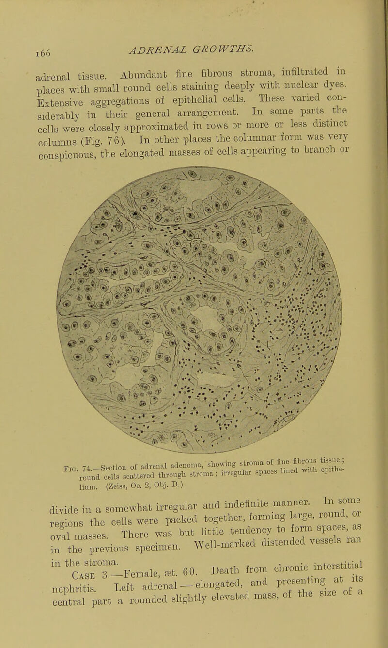 adreiical tissue. Abundant fine fibrous stroma, infiltrated in places with small round cells staining deeply with nuclear dyes. Extensive aggregations of epithelial cells. These varied con- siderably in° tlieir general arrangement. In some parts the cells were closely approximated in rows or more or less distinct columns (Fig. 76). In other places the columnar form was very conspicuousrthe elongated masses of cells appearing to branch or lium. (Zeiss, Oc. 2, Obj. D.) divide in a somewhat irregular and indefi^rite manner. In some Lions the cells were packed together, formmg large, round, oi oval masses There was but little tendency to form spaces, as Ttiri^evious specimen. Well-marlced distended vessels ran r-Female. cet. 60. Death from chronic inter^itial nephritis. Left adrenal - elongated, and P--t-g at ^t central part a rounded slightly elevated mass, of the size