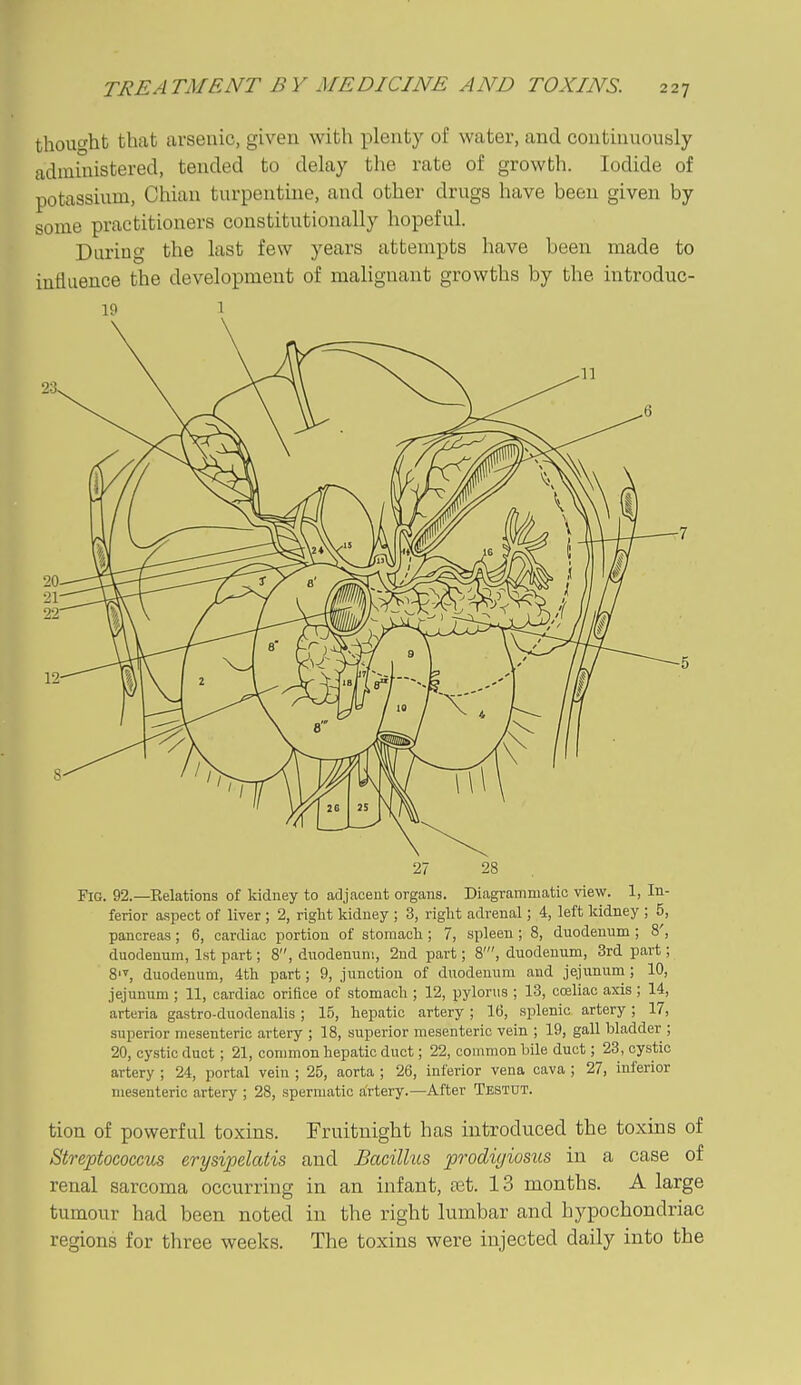 thouohb that arsenic, given with plenty of water, and continuously adaaiuistered, tended to delay the rate of growth. Iodide of potassium, Chian turpentine, and other drugs have been given by some practitioners constitutionally hopeful. During the last few years attempts have been made to iufluence the development of malignant growths by the introduc- 19 1 27 28 Fig. 92.—Kelations of kidney to adjacent organs. Diagrammatic view. 1, In- ferior aspect of liver ; 2, right kidney ; 3, right adrenal; 4, left kidney ; 5, pancreas; 6, cardiac portion of stomacli; 7, spleen ; 8, duodenum ; 8', duodenum, 1st part; 8, duodenum, 2nd part; 8', duodenum, 3rd part; duodenum, 4th part; 9, junction of duodenum and jejunum; 10, jejunum ; 11, cardiac orifice of stomach ; 12, pylorus ; 13, cceliac axis; 14, arteria gastro-duodenalis; 15, hepatic artery; 16, splenic artery; 17, superior mesenteric artery ; 18, superior mesenteric vein ; 19, gall bladder ; 20, cystic duct ; 21, common hepatic duct; 22, common bile duct; 23, cystic artery ; 24, portal vein ; 25, aorta ; 26, inferior vena cava ; 27, inferior mesenteric artery ; 28, spermatic artery.—After Testut. tion of powerful toxins. Fruitnight has introduced the toxins of Streptococci erysipelatis and Bacillus pvdigiosus in a case of renal sarcoma occurring in an infant, set. 13 months. A large tumour had been noted in the right lumbar and hypochondriac regions for three weeks. The toxins were injected daily into the