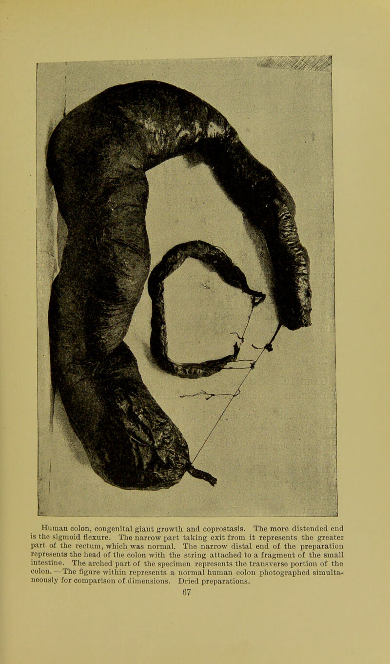 Human colon, congenital giant growth and coprostasis. Tlie more distended end is the sigmoid flexure. The narrow part taking exit from it represents the greater part of the rectum, which was normal. Tlie narrow distal end of the preparation represents the head of the colon with the string attached to a fragment of the small intestine. The arched part of the specimen represents the transverse portion of the colon.—The figure within represents a normal human colon photographed simulta- neously for comparison of dimensions. Dried preparations. G7