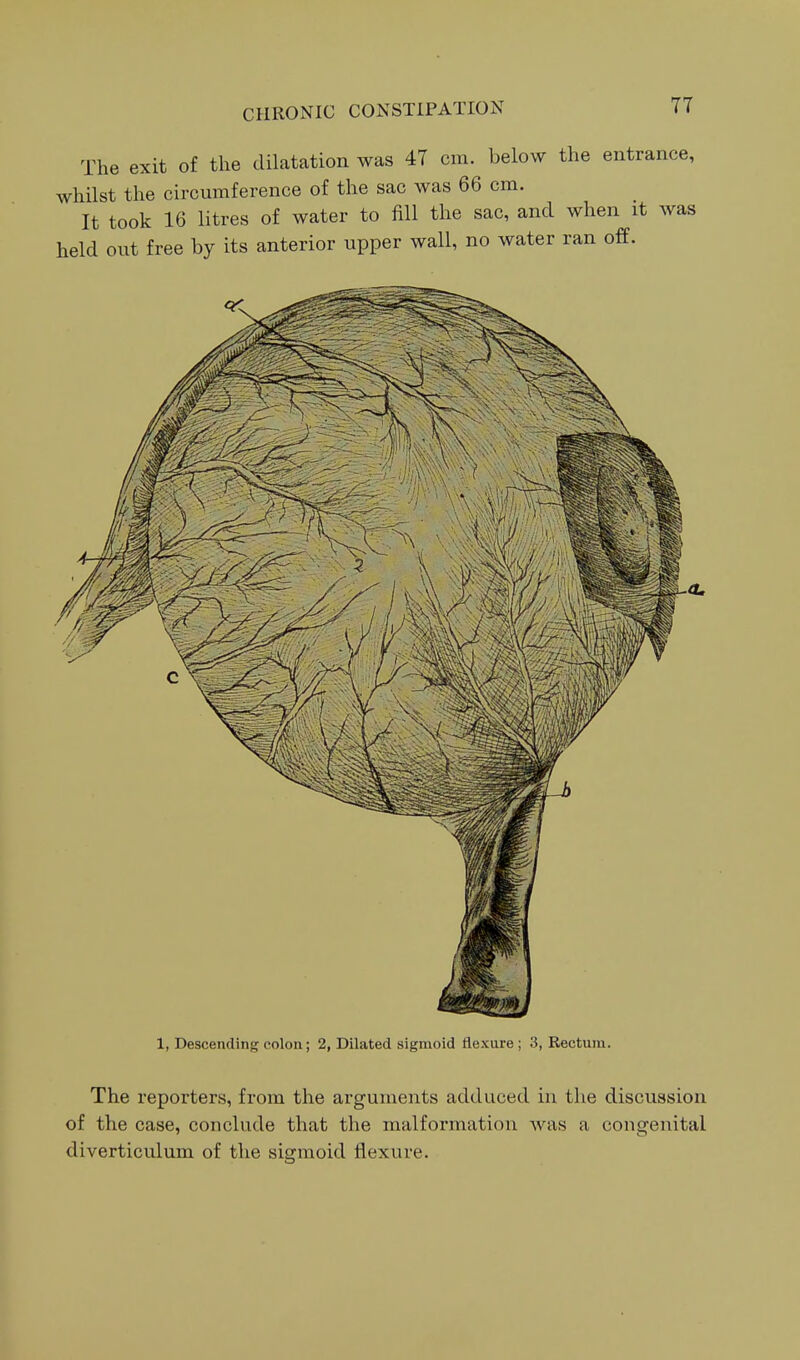 The exit of the dilatation was 47 cm. below the entrance, whilst the circumference of the sac was 66 cm. It took 16 litres of water to fill the sac, and when it was held out free by its anterior upper wall, no water ran off. 1, Descending colon; 2, Dilated sigmoid flexure ; 3, Rectum. The reporters, from the arguments adduced in the discussion of the case, conclude that the malformation was a congenital diverticulum of the sigmoid flexure.