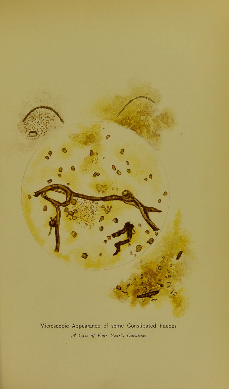 Microscopic Appearance of some Constipated Faeces Ji Case of Four Year's Duration