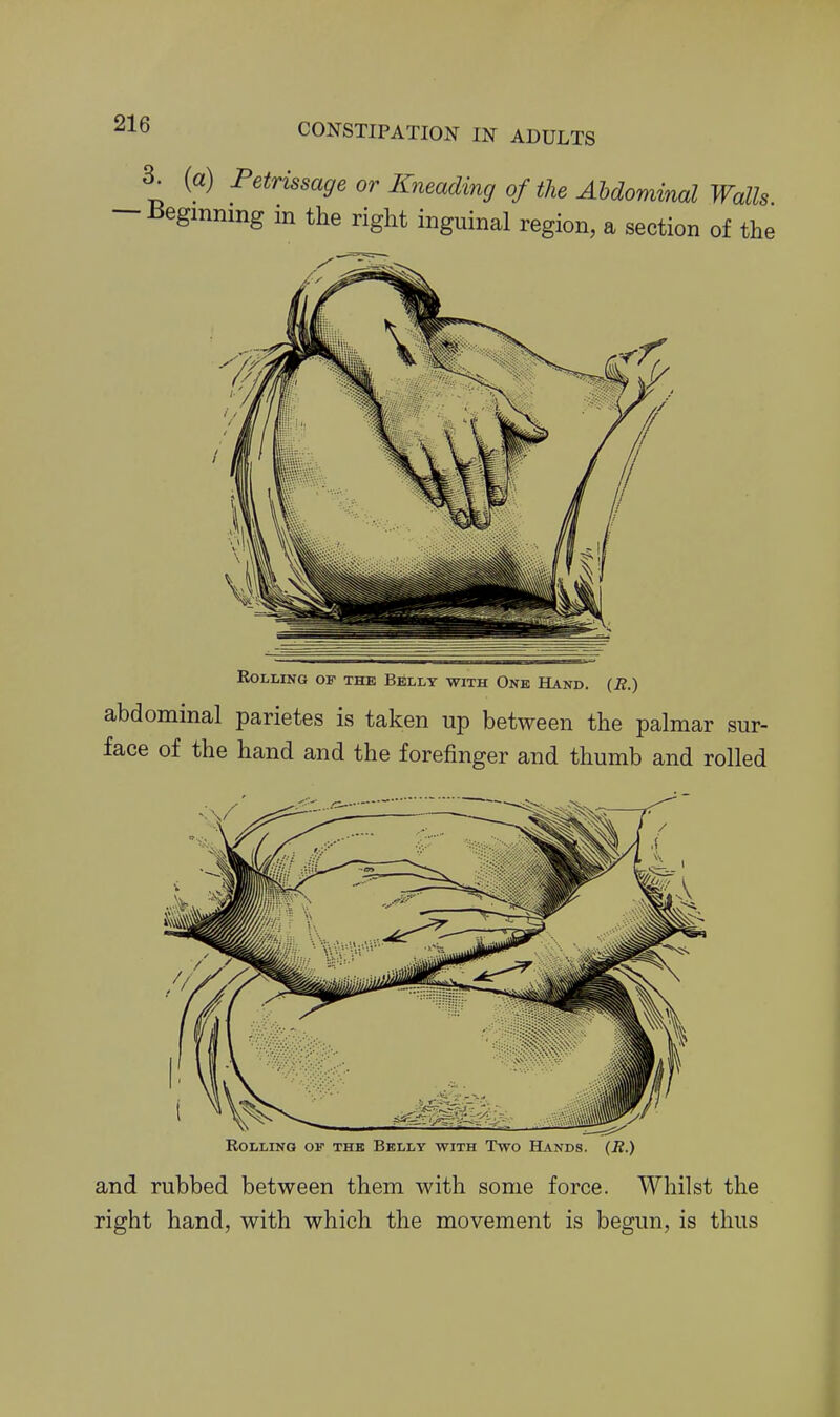 3. (a) Petrissage or Kneading of the Abdominal Walls — i^egmnmg m the right inguinal region, a section of the Rolling of the Belly with One Hand. (E.) abdominal parietes is taken up between the palmar sur- face of the hand and the forefinger and thumb and rolled ROLLINQ OF THE BkLLY WITH TwO HaNDS. (R.) and rubbed between them with some force. Whilst the right hand, with which the movement is begun, is thus