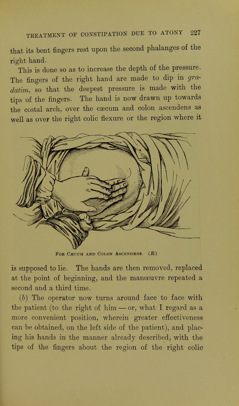 that its bent fingers rest upon the second phalanges of the right hand. This is done so as to increase the depth of the pressure. The fingers of the right hand are made to dip in gra- datim, so that the deepest pressure is made with the tips of the fingers. The hand is now drawn up towards the costal arch, over the caecum and colon ascendens as well as over the right colic flexure or the region where it Fob C^cum and Colon Ascendens. (JZ.) is supposed to lie. The hands are then removed, replaced at the point of beginning, and the manoeuvre repeated a second and a third time. (6) The operator now turns around face to face with the patient (to the right of him — or, what I regard as a more convenient position, wherein greater effectiveness can be obtained, on the left side of the patient), and plac- ing his hands in the manner already described, with the tips of the fingers about the region of the right colic