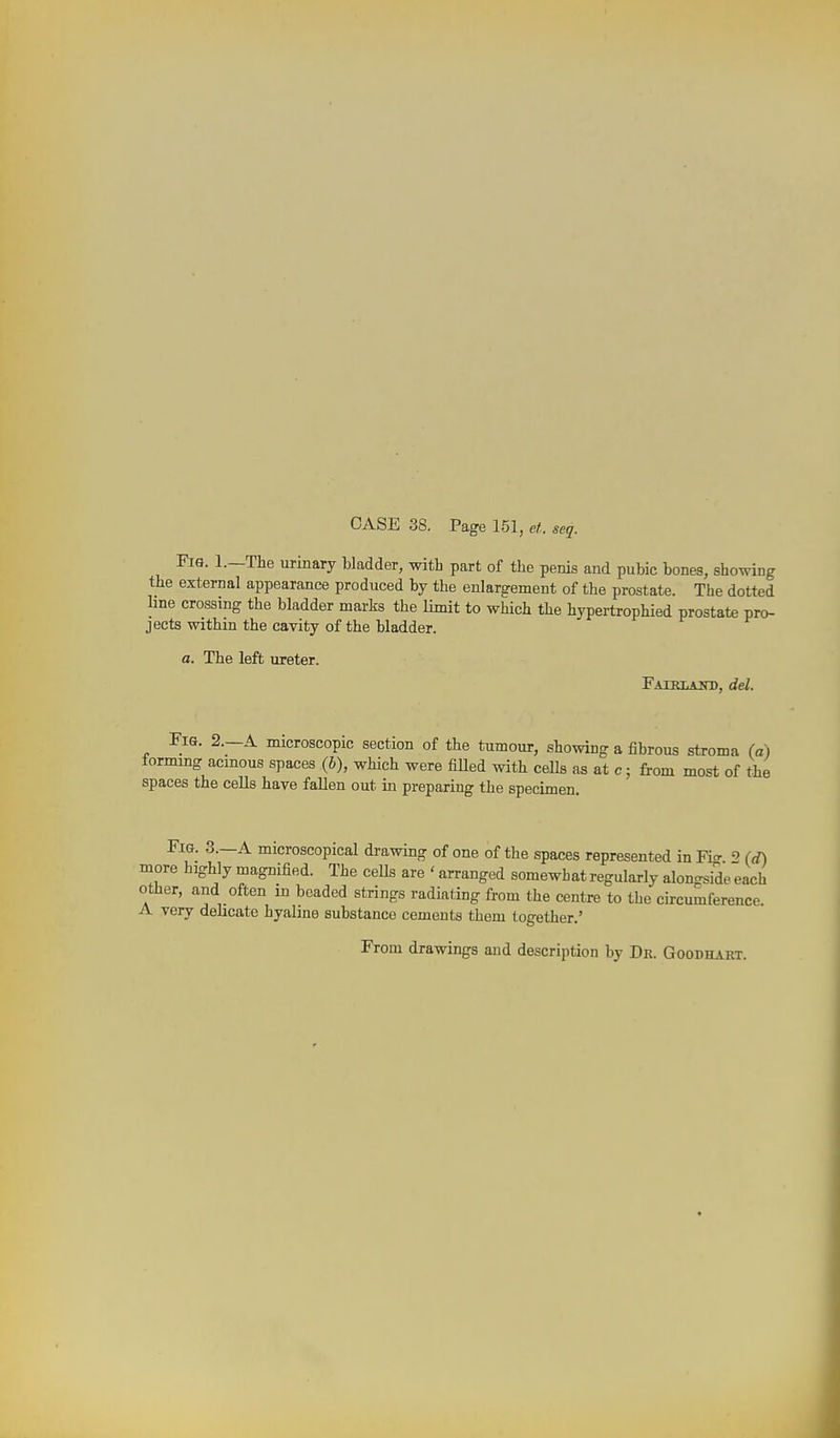 CASE 38. Page 151, el. seq. Fis. 1.—The urmary bladder, with part of the penis and pubic bones, showing the external appearance produced by the enlargement of the prostate. The dotted line crossing the bladder marks the limit to which the hypertrophied prostate pro- jects within the cavity of the bladder. a. The left ureter. FATRLAjrD, dd. Fis. 2.—a microscopic section of the tumour, showing a fibrous stroma (a) formmg acmous spaces (b), which were fiUed with ceUs as at c; from most of the spaces the cells have fallen out in preparing the specimen. Fig. 3.—a microscopical drawing of one of the spaces represented in Fig 2 (d) more highly magnified. The cells are ' arranged somewhat regularly alongside each other, and often in beaded strings radiating from the centre to the circumference. A very delicate hyaline substance cements them together.' From drawings and description by Dr. GoorHART.