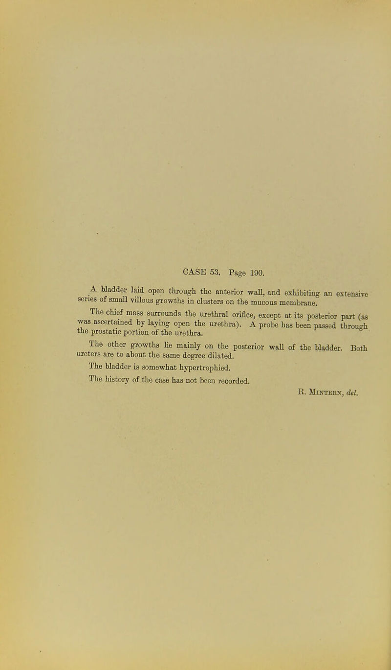 A bladder laid open through the anterior waU, and exhibiting an extensive series of small villous growths in clusters on the mucous membrane. The chief mass surrounds the urethral orifice, except at its posterior part (as was ascertamed by laying open the urethra). A probe has been passed through the prostatic portion of the urethra. The other growths lie mainly on the posterior waU of the bladder. Both ureters are to about the same degree dilated. The bladder is somewhat hypertrophied. The history of the case has not been recorded. R. MiNTERN, del.