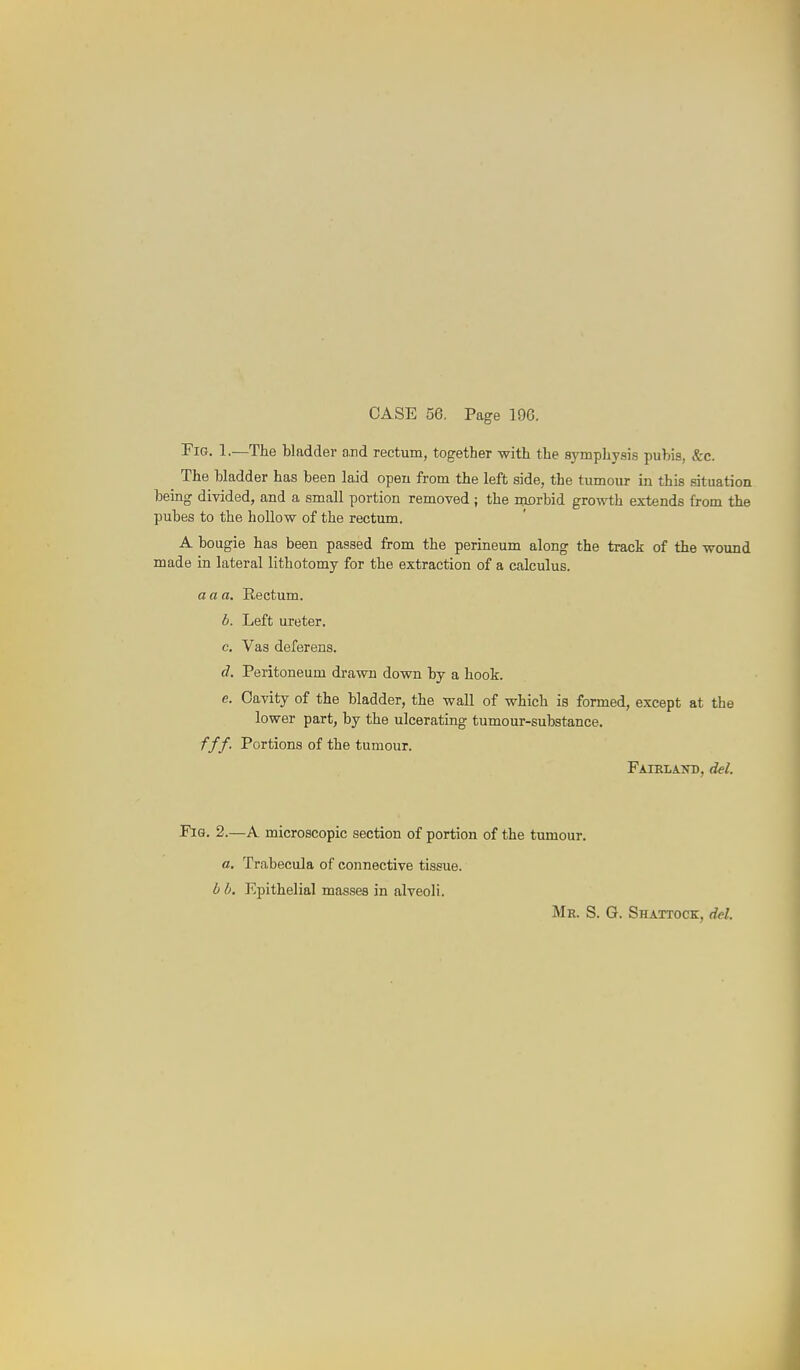 Fig. 1.—The bladder a.iid rectum, together with the symphysis pubis, &c. The bladder has been laid open from the left side, the tumour in this situation being divided, and a small portion removed ; the morbid growth extends from the pubes to the hollow of the rectum. A bougie has been passed from the perineum along the track of the wound made in lateral lithotomy for the extraction of a calculus. a a a. Rectum. d. Left ureter. c. Vas deferens. d. Peritoneum drawn down by a hook. e. Cavity of the bladder, the wall of which is formed, except at the lower part, by the ulcerating tumour-substance. fff. Portions of the tumour. Faieiant), del. Fig. 2.—A microscopic section of portion of the tumour. a. Trabecula of connective tissue. d I). Kpithelial masses in alveoli. Mr. S. G. Shattock, del.